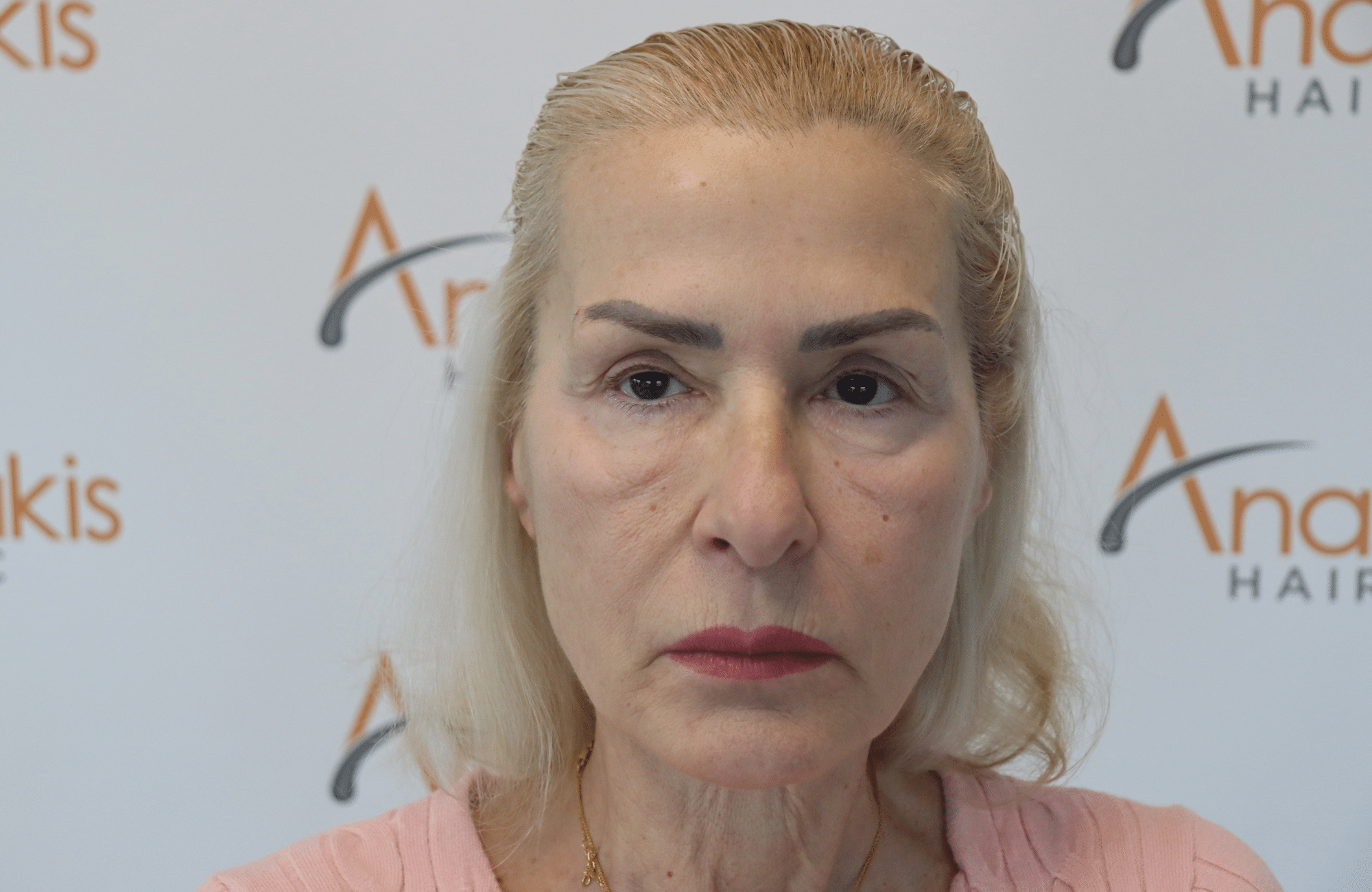 hair transplant result