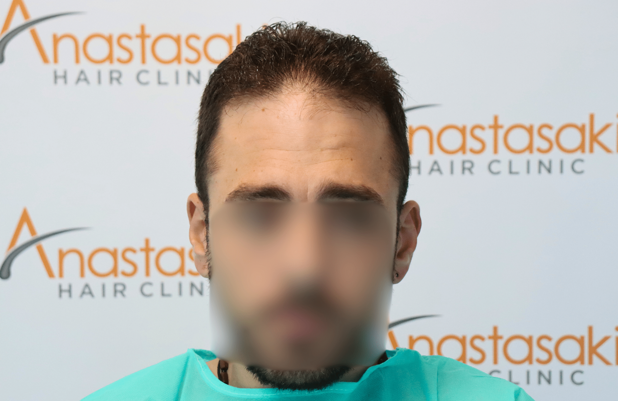 hair transplant result