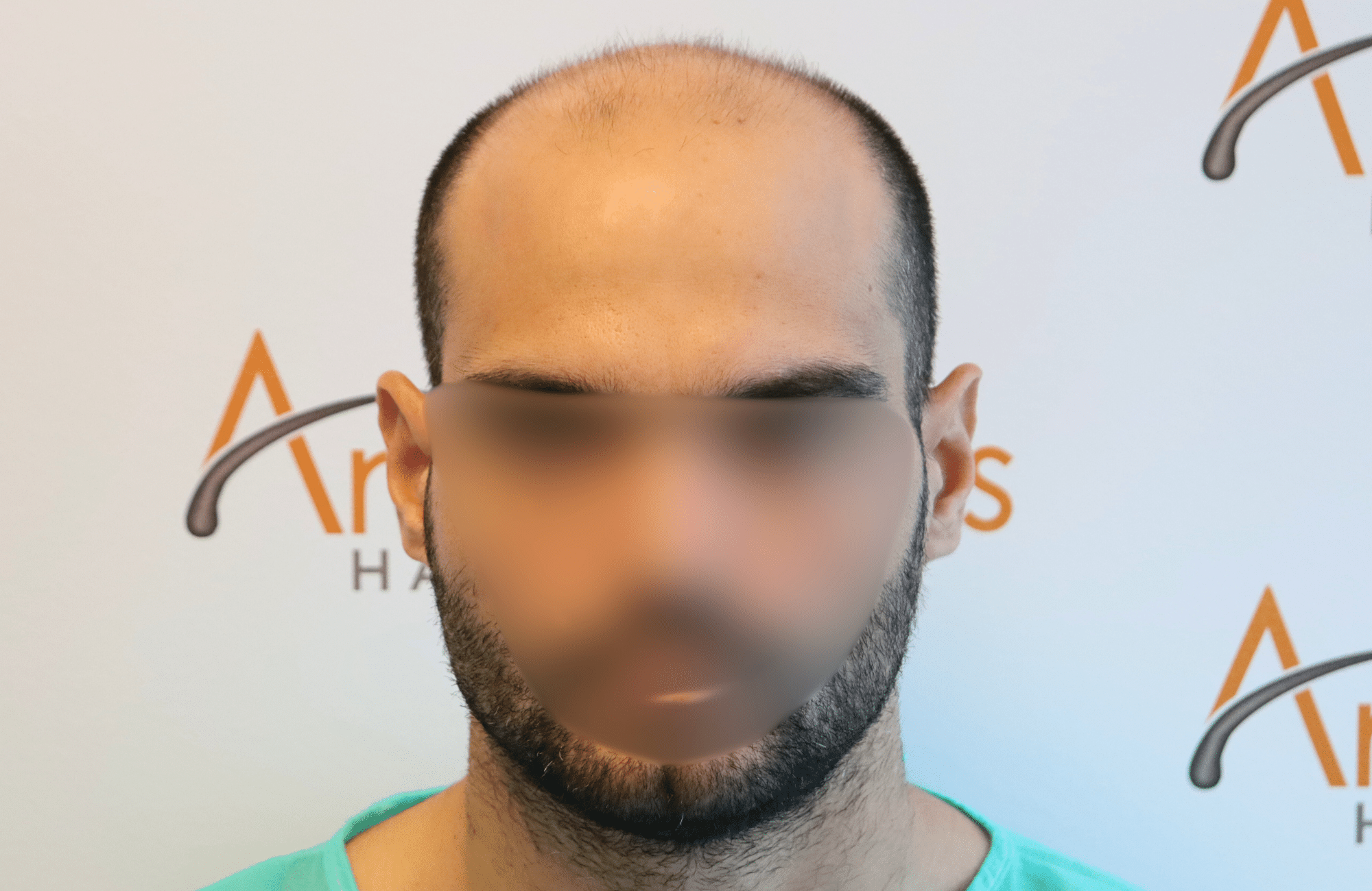 hai transplant result 3500 fus