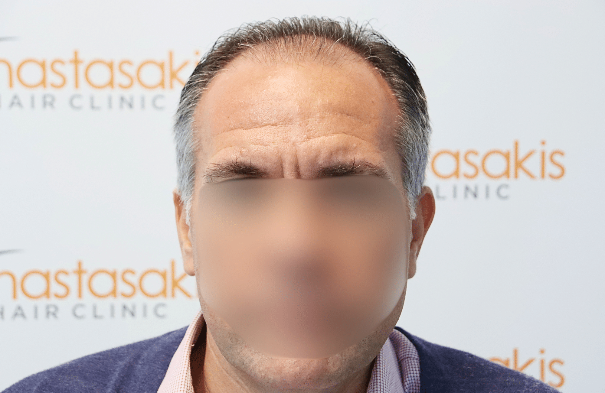 hair transplant result 2600