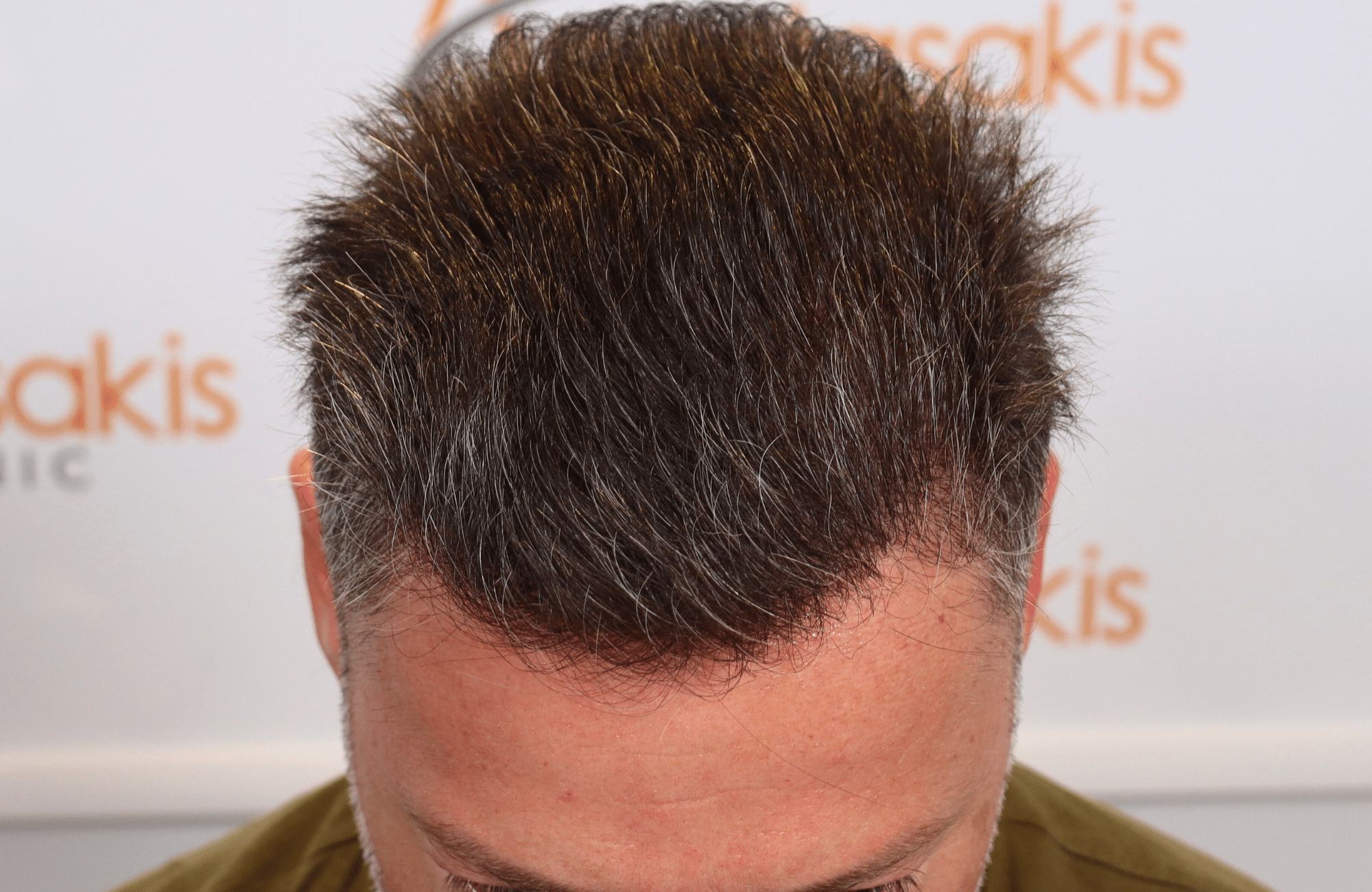 hair transplant result
