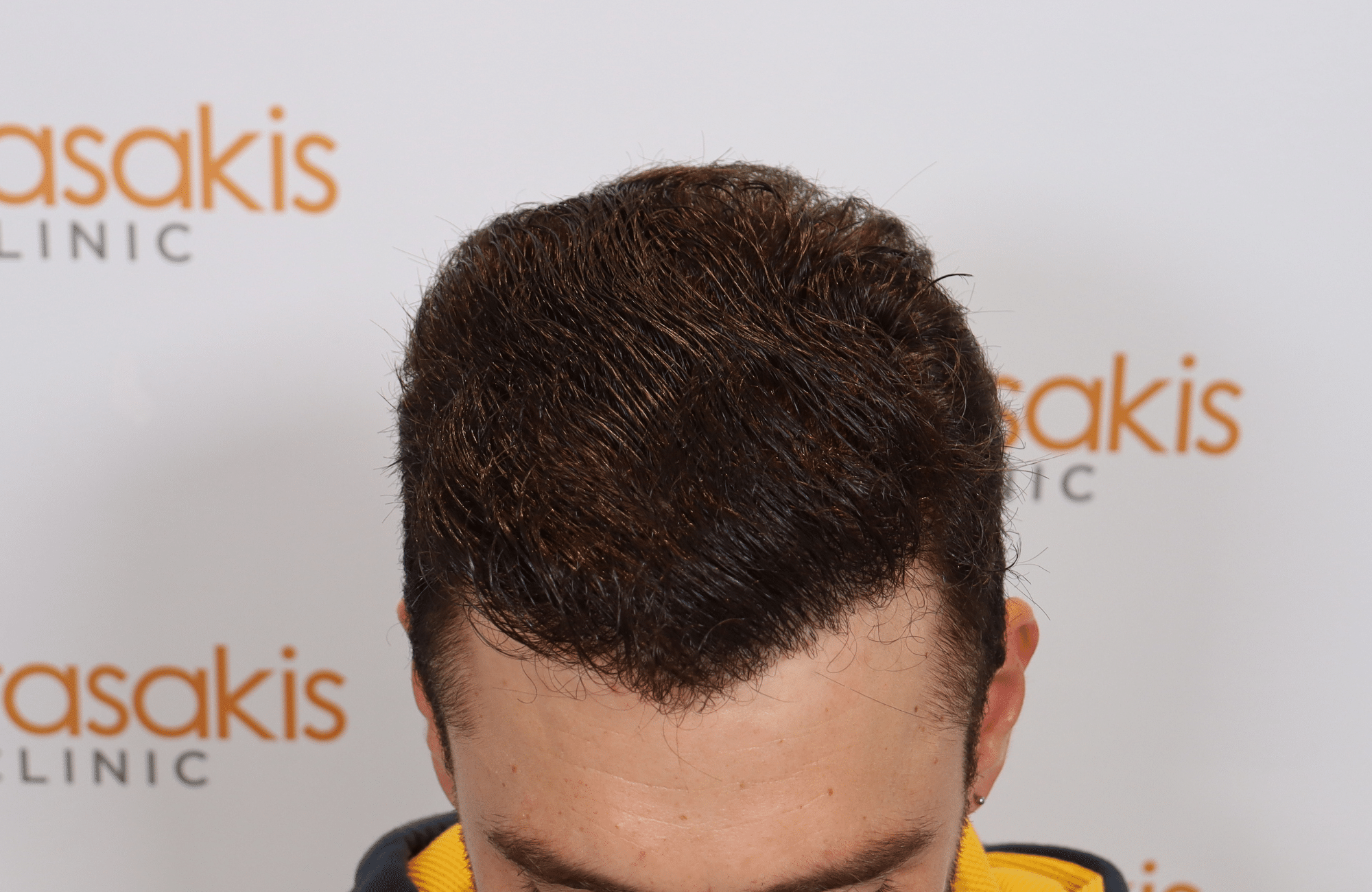 hair transplant result