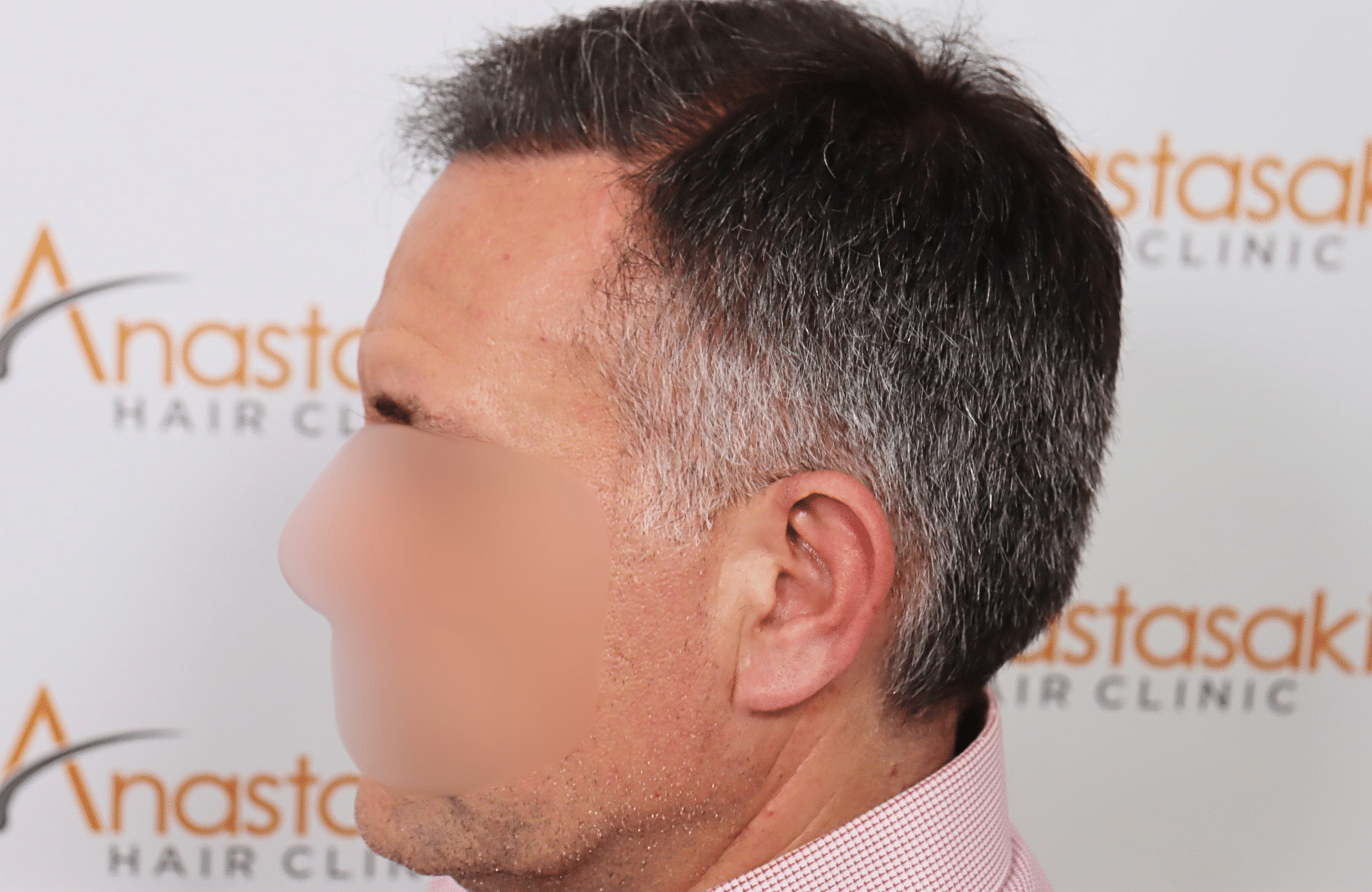 hair transplant result 2600