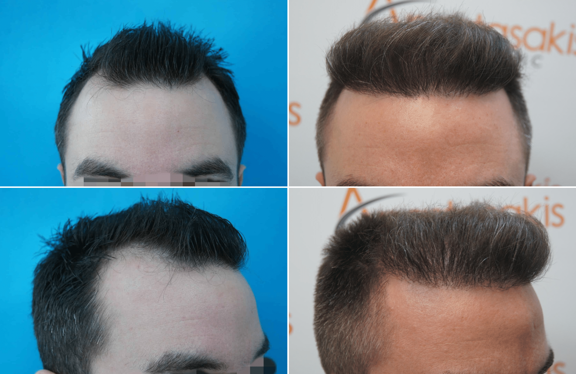 https://www.anastasakishairclinic.gr/portfolio/apotelesma-metamosxefsis-mallion-anastasakis-hair-clinic-100/