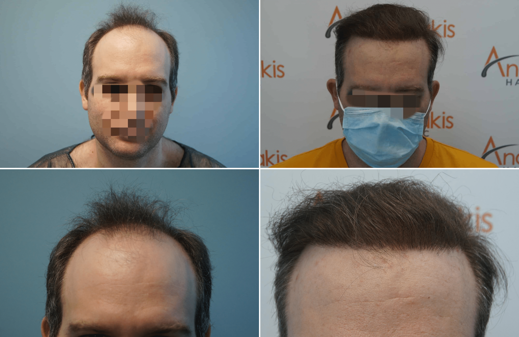 https://www.anastasakishairclinic.gr/portfolio/apotelesma-metamosxefsis-mallion-anastasakis-hair-clinic-102/