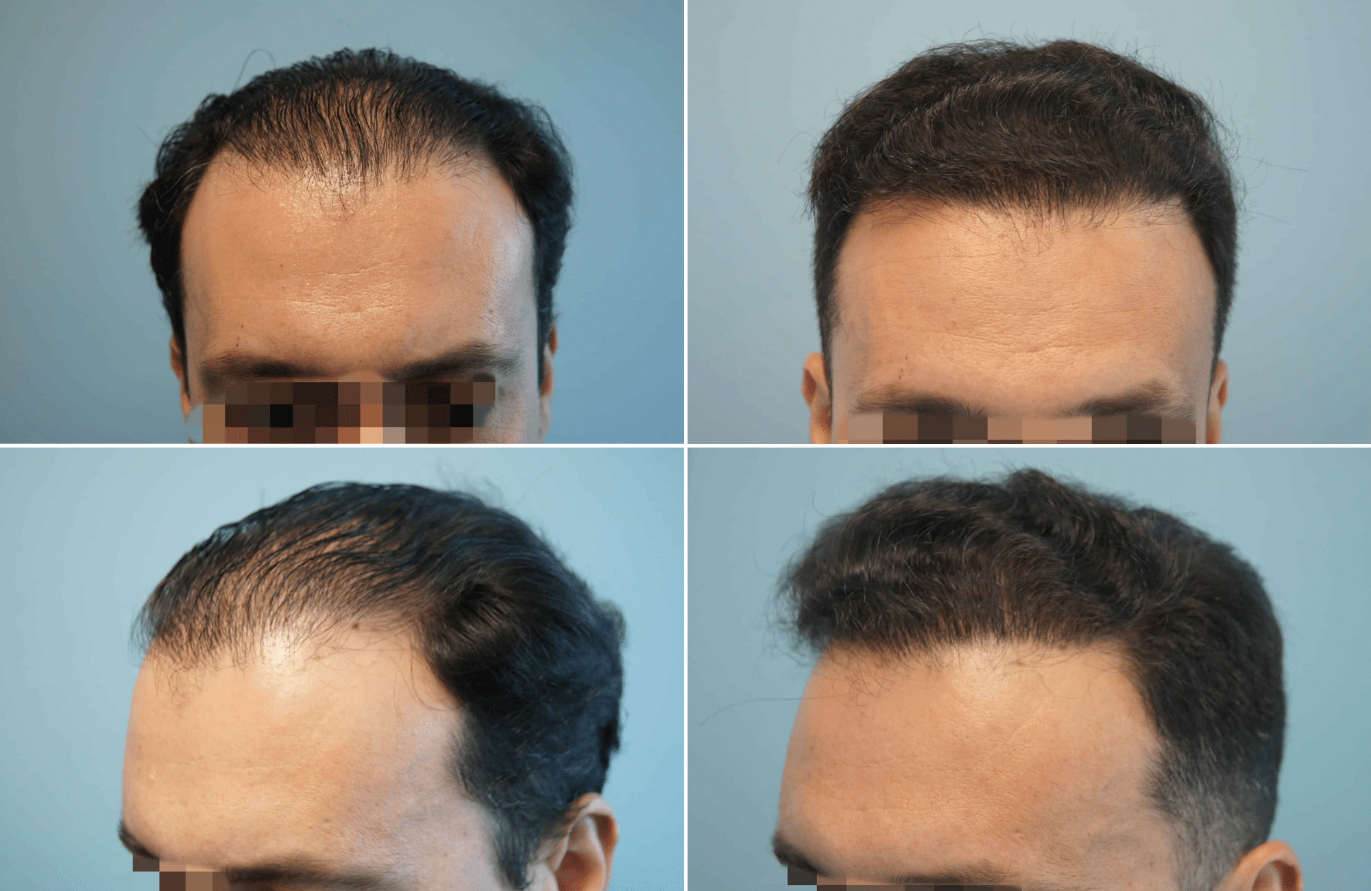 https://www.anastasakishairclinic.gr/portfolio/apotelesma-metamosxefsis-mallion-anastasakis-hair-clinic-103/