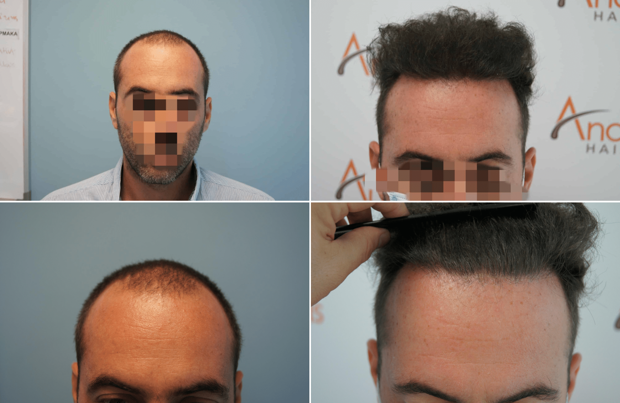 https://www.anastasakishairclinic.gr/portfolio/apotelesma-metamosxefsis-mallion-anastasakis-hair-clinic-105/