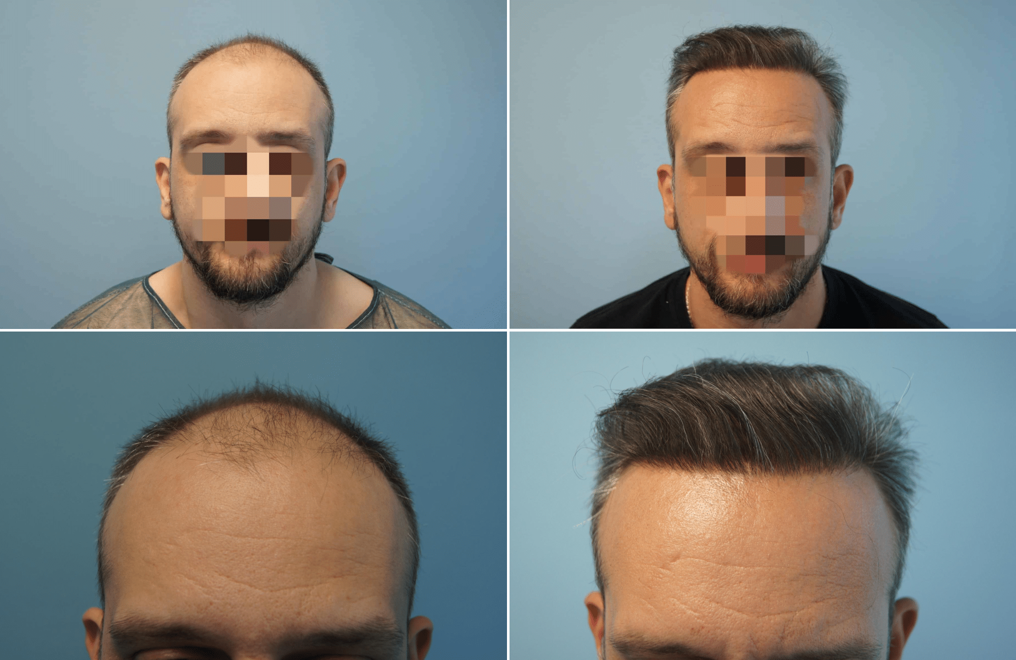 https://www.anastasakishairclinic.gr/portfolio/apotelesma-metamosxefsis-mallion-anastasakis-hair-clinic-106/