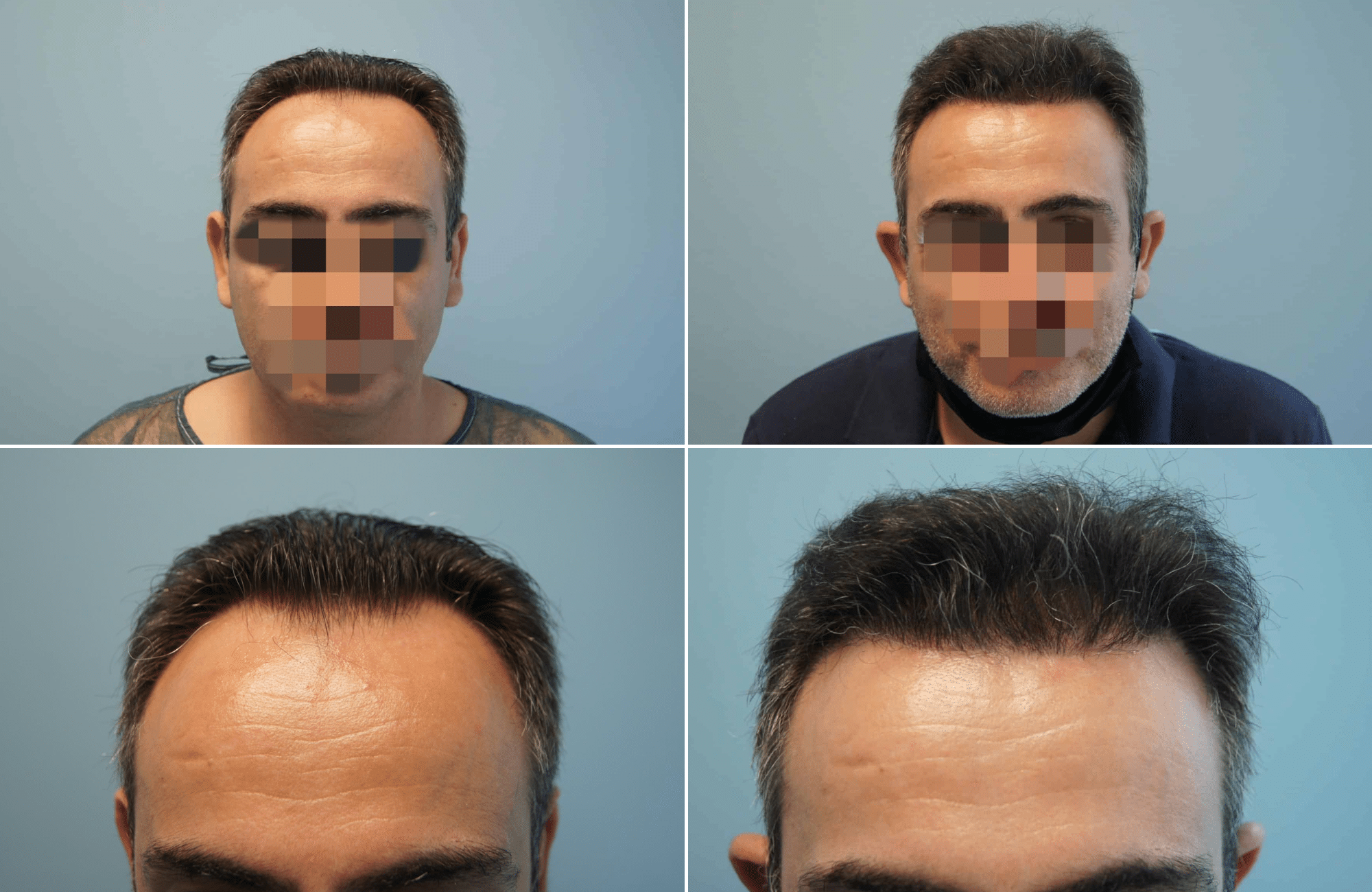 https://www.anastasakishairclinic.gr/portfolio/apotelesma-metamosxefsis-mallion-anastasakis-hair-clinic-107/