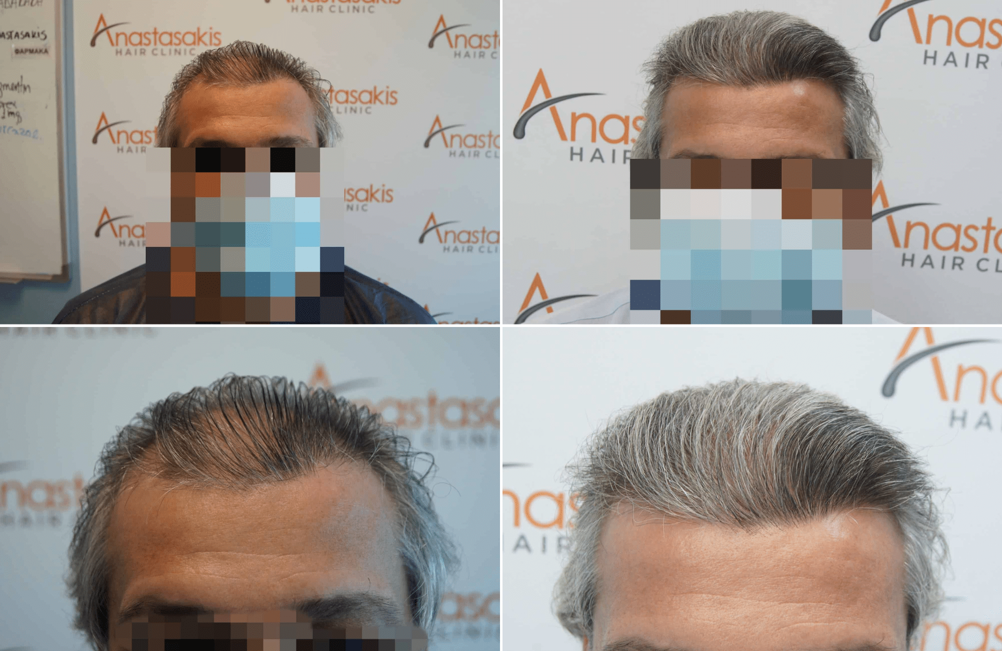 https://www.anastasakishairclinic.gr/portfolio/apotelesma-metamosxefsis-mallion-anastasakis-hair-clinic-108/