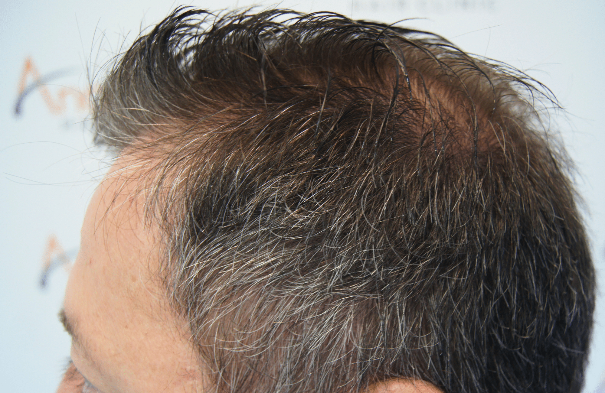 hair transplant result