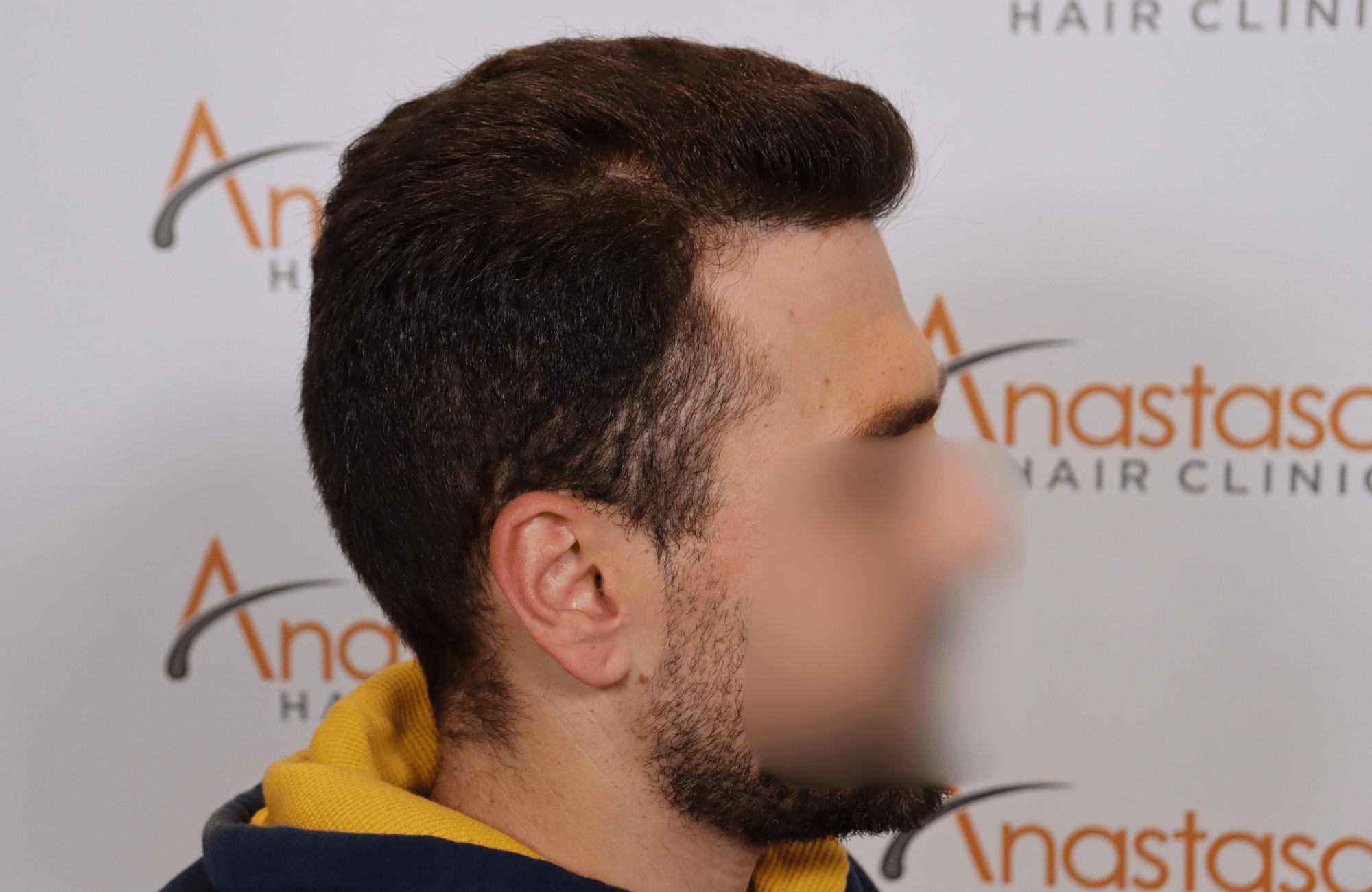 hair transplant result