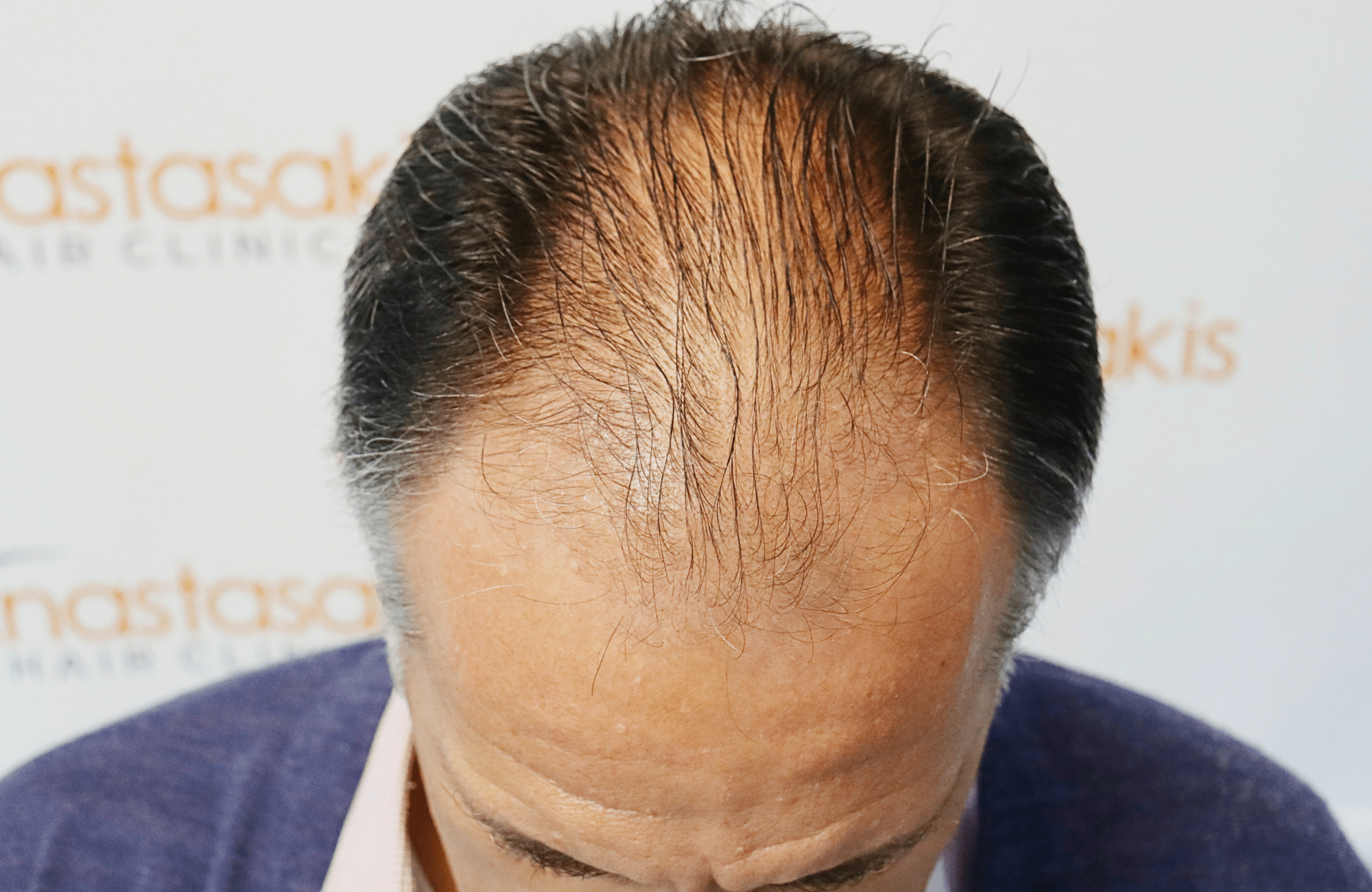 hair transplant result 2600