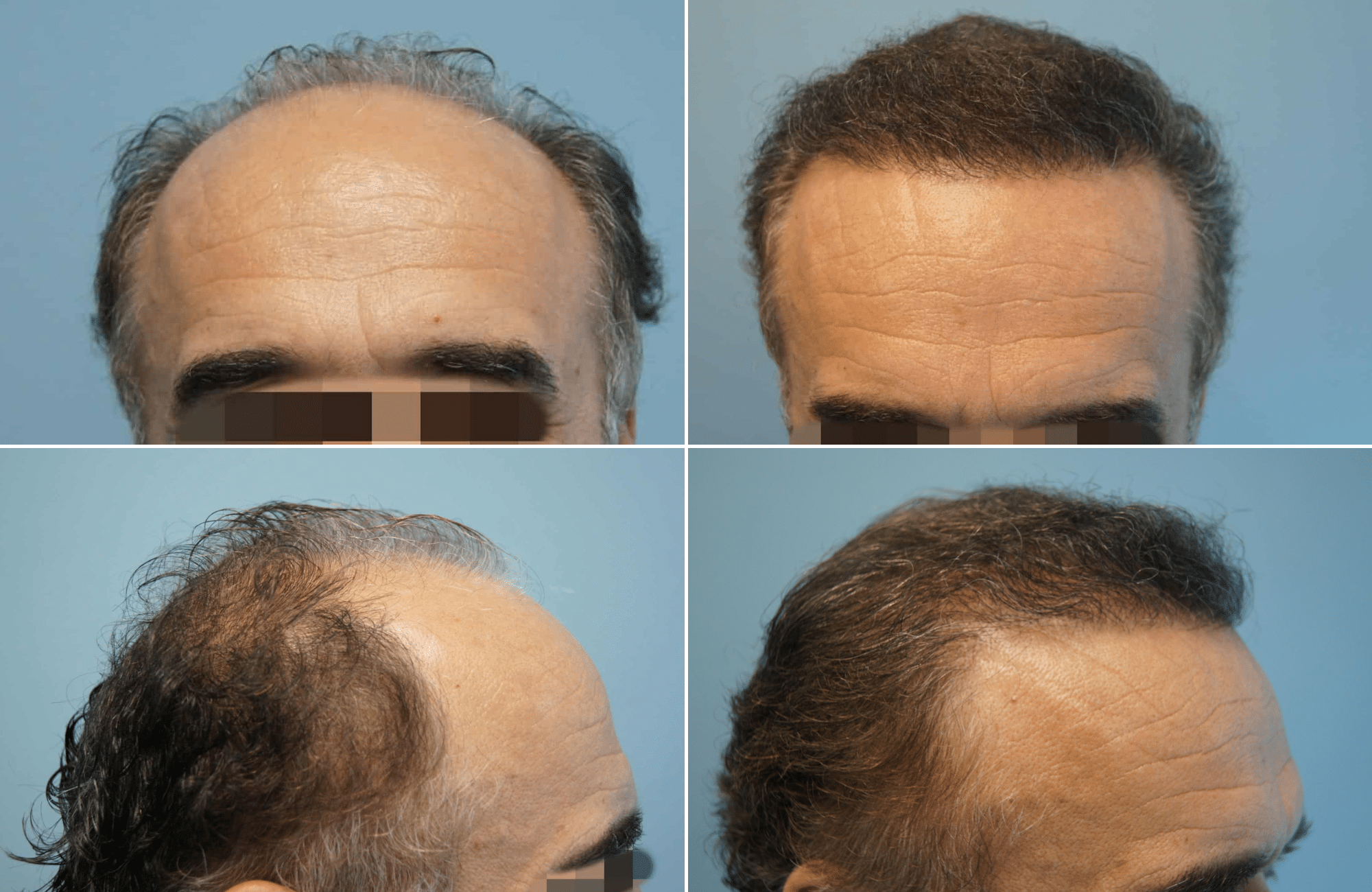 https://www.anastasakishairclinic.gr/portfolio/apotelesma-metamosxefsis-mallion-anastasakis-hair-clinic-110/