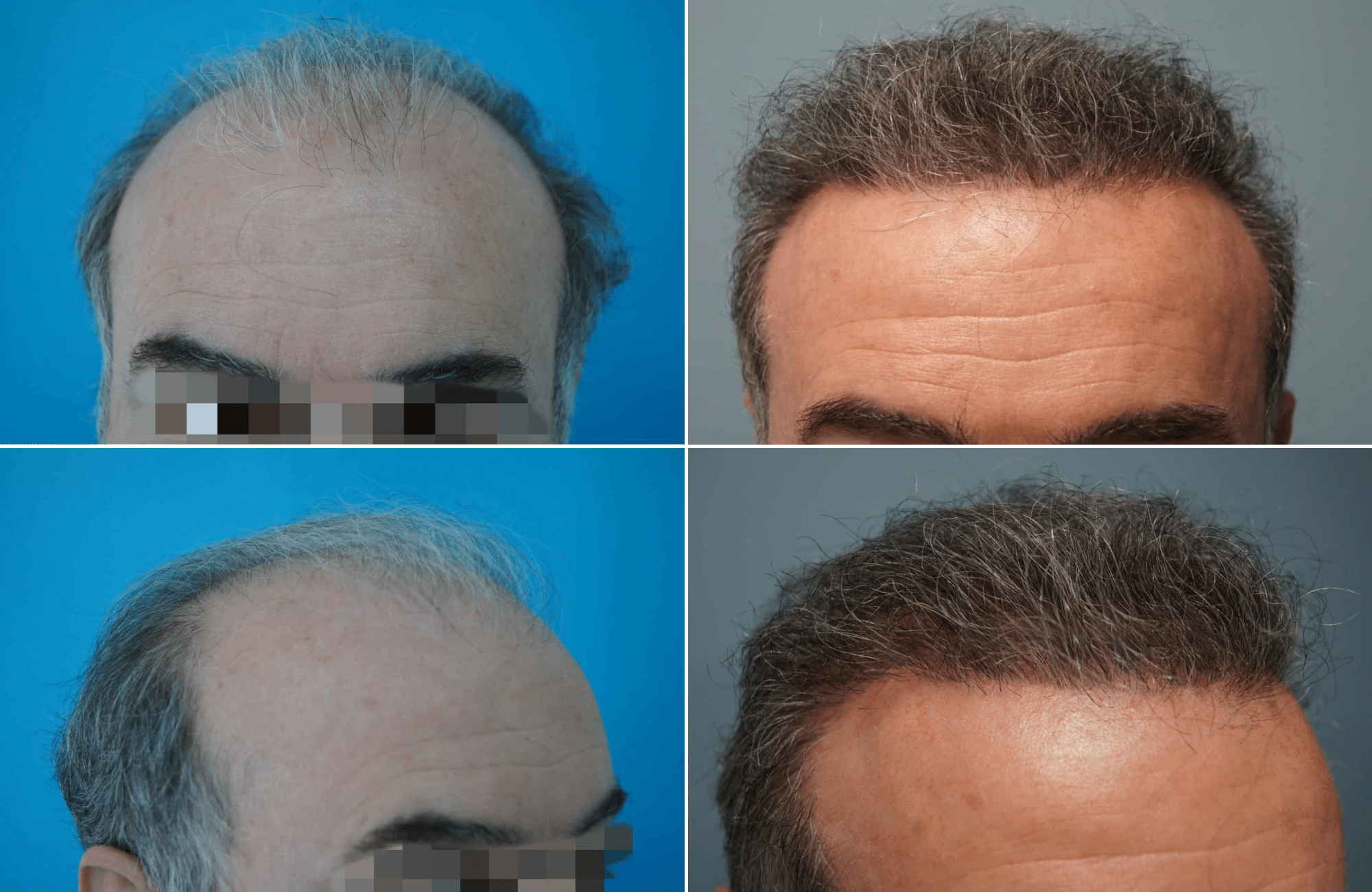 https://www.anastasakishairclinic.gr/portfolio/apotelesma-metamosxefsis-mallion-anastasakis-hair-clinic-114/