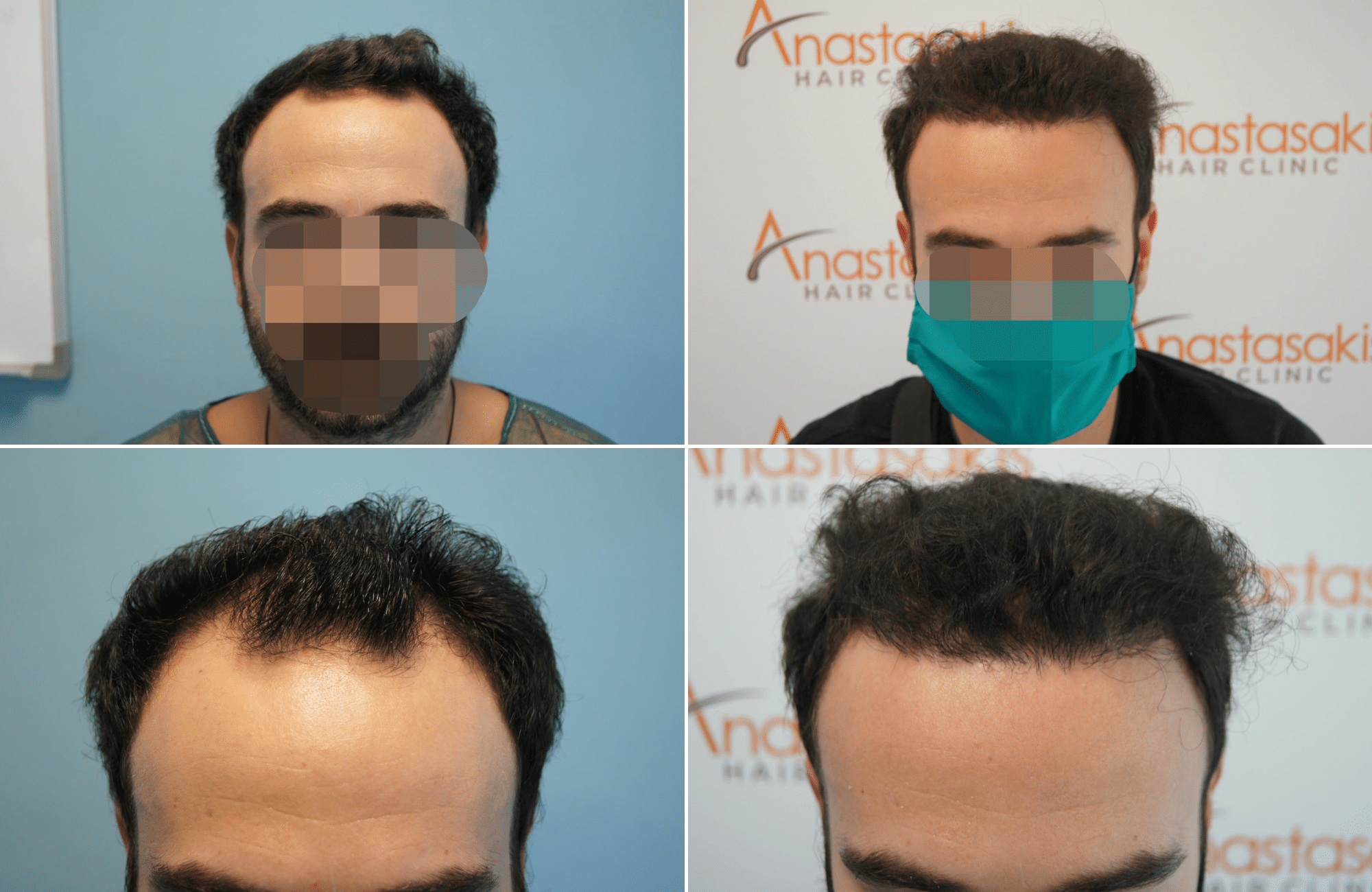 https://www.anastasakishairclinic.gr/portfolio/apotelesma-metamosxefsis-mallion-anastasakis-hair-clinic-115/