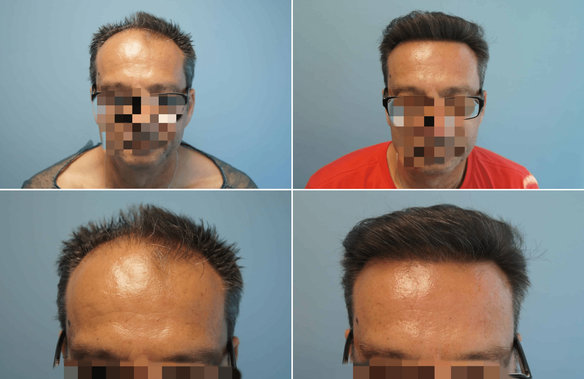 https://www.anastasakishairclinic.gr/portfolio/apotelesma-metamosxefsis-mallion-anastasakis-hair-clinic-116/