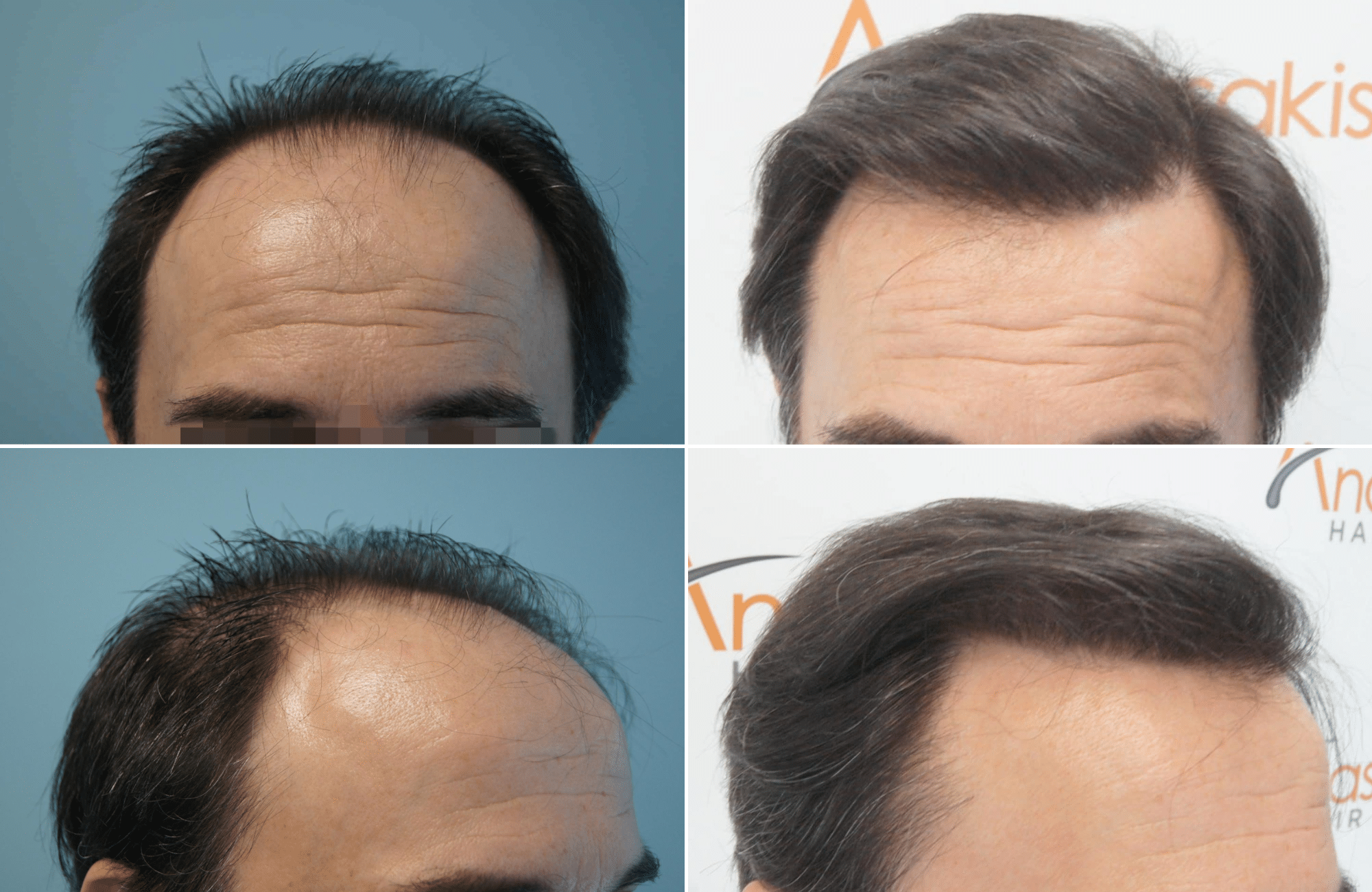 https://www.anastasakishairclinic.gr/portfolio/apotelesma-metamosxefsis-mallion-anastasakis-hair-clinic-118/