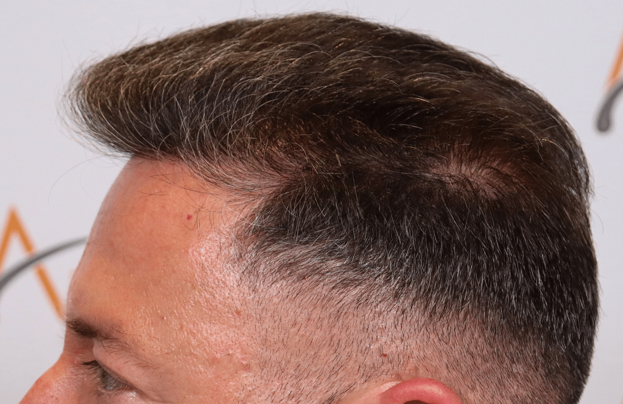 hair transplant result