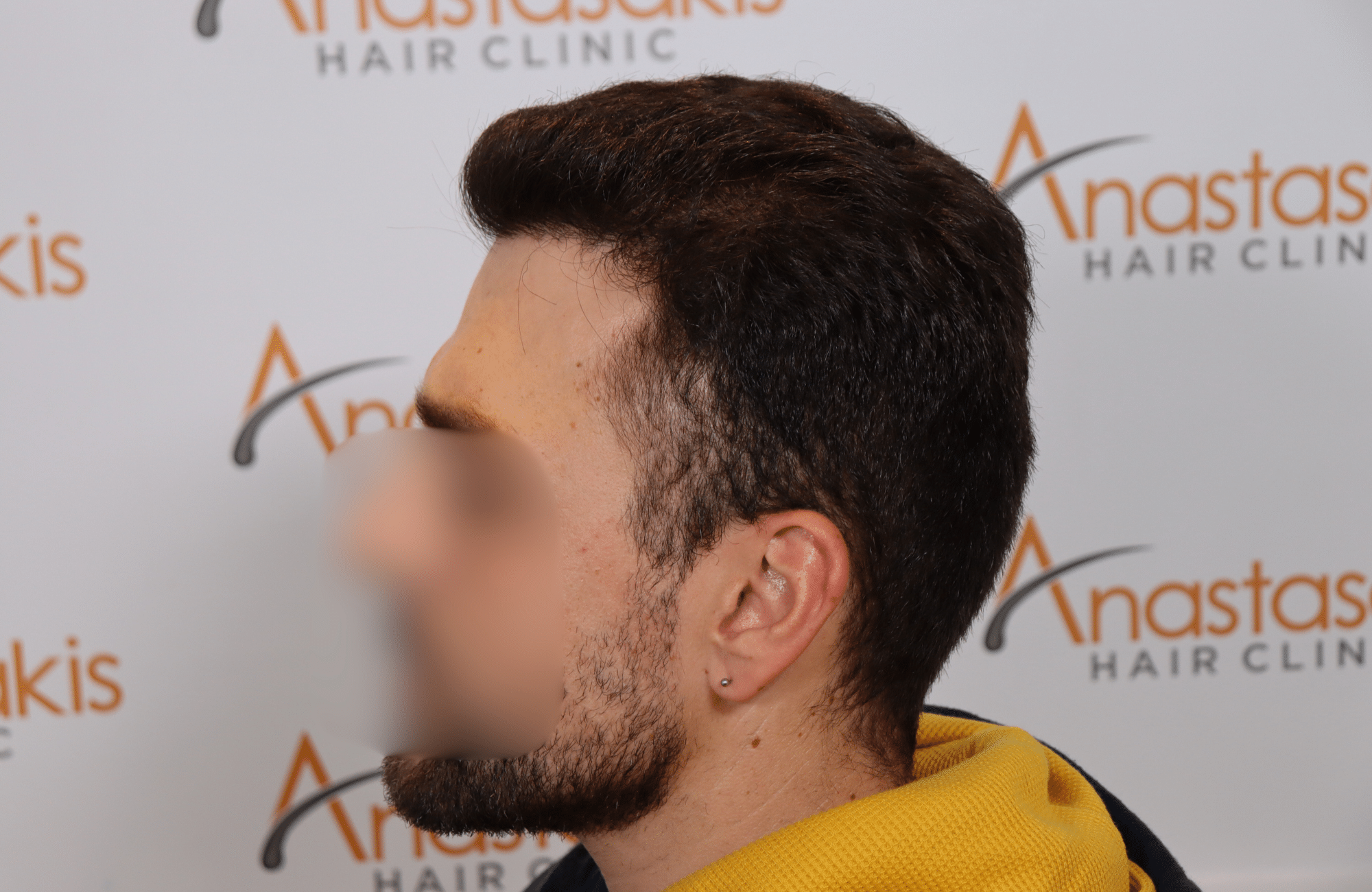 hair transplant result