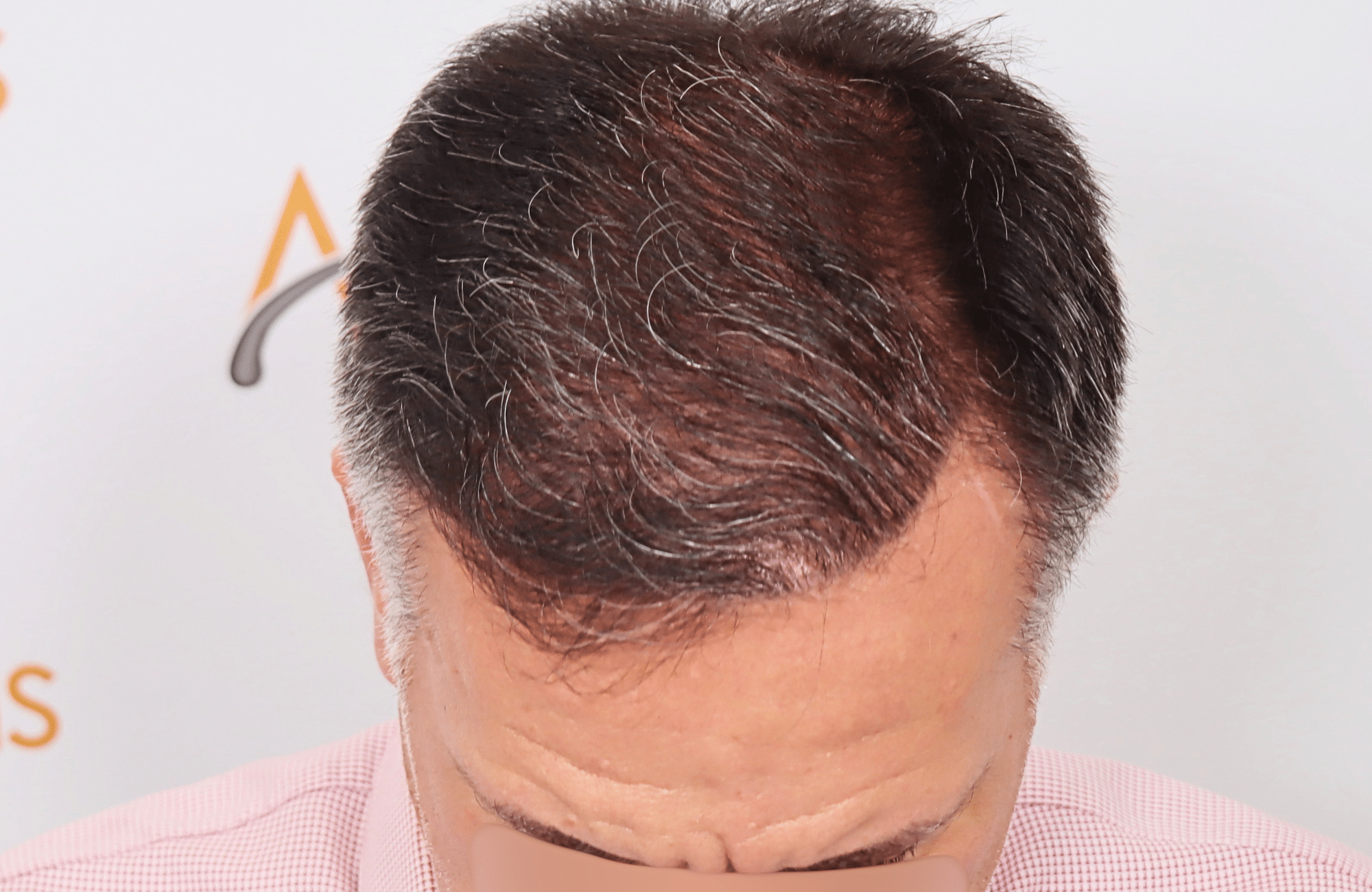 hair transplant result 2600