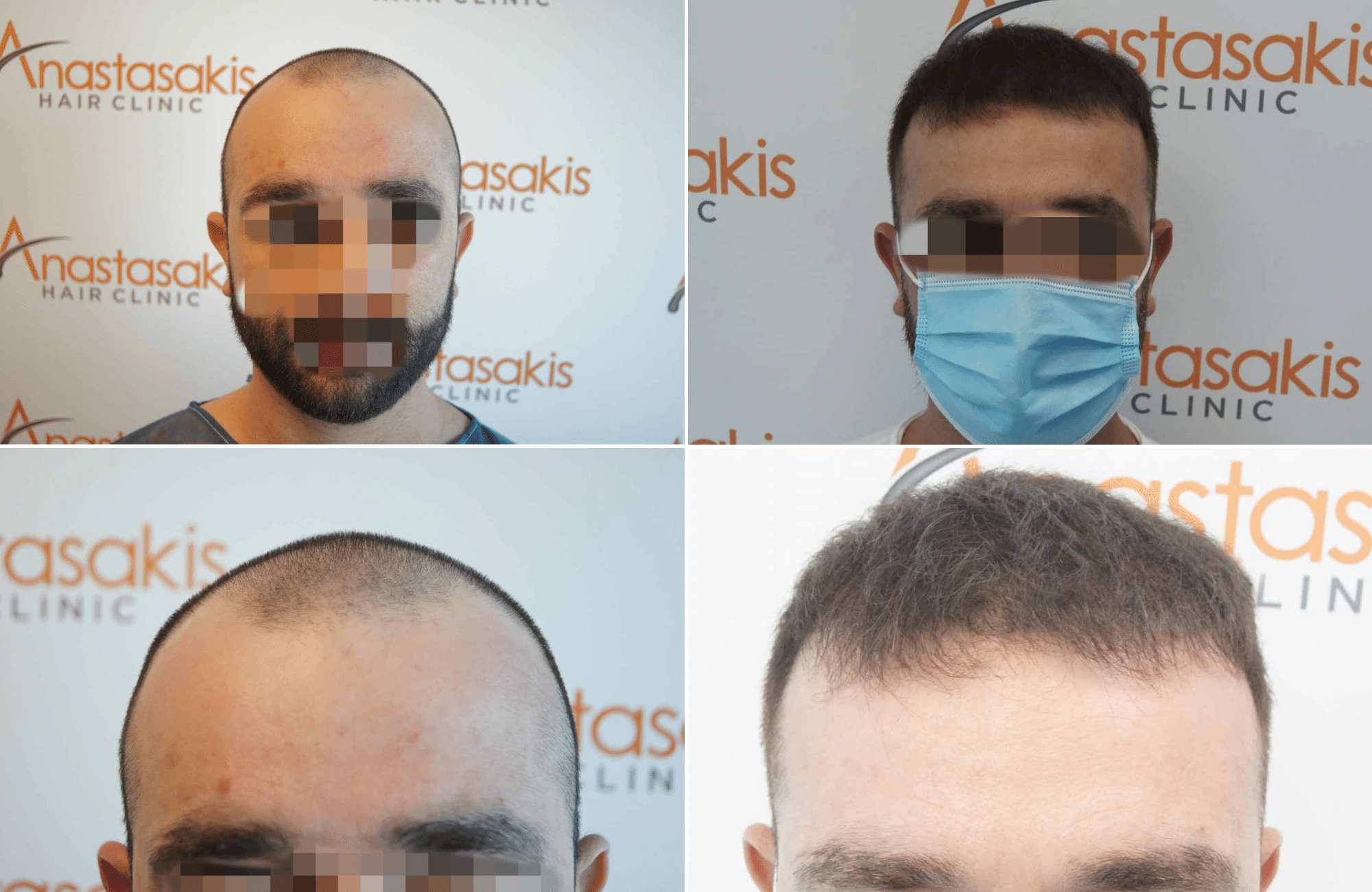 https://www.anastasakishairclinic.gr/portfolio/apotelesma-metamosxefsis-mallion-anastasakis-hair-clinic-121/