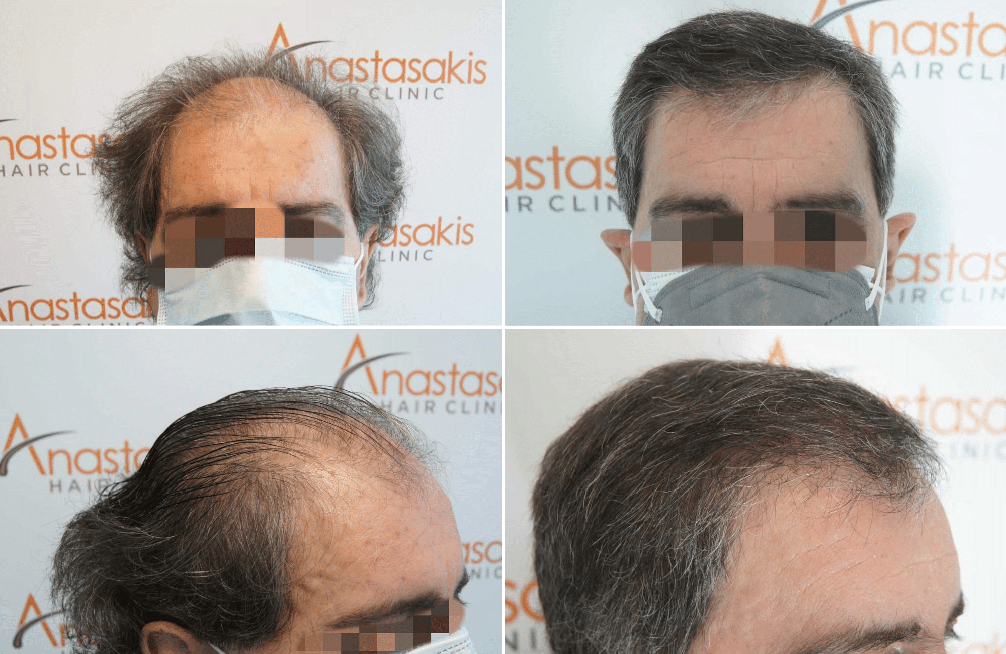 https://www.anastasakishairclinic.gr/portfolio/apotelesma-metamosxefsis-mallion-anastasakis-hair-clinic-123/