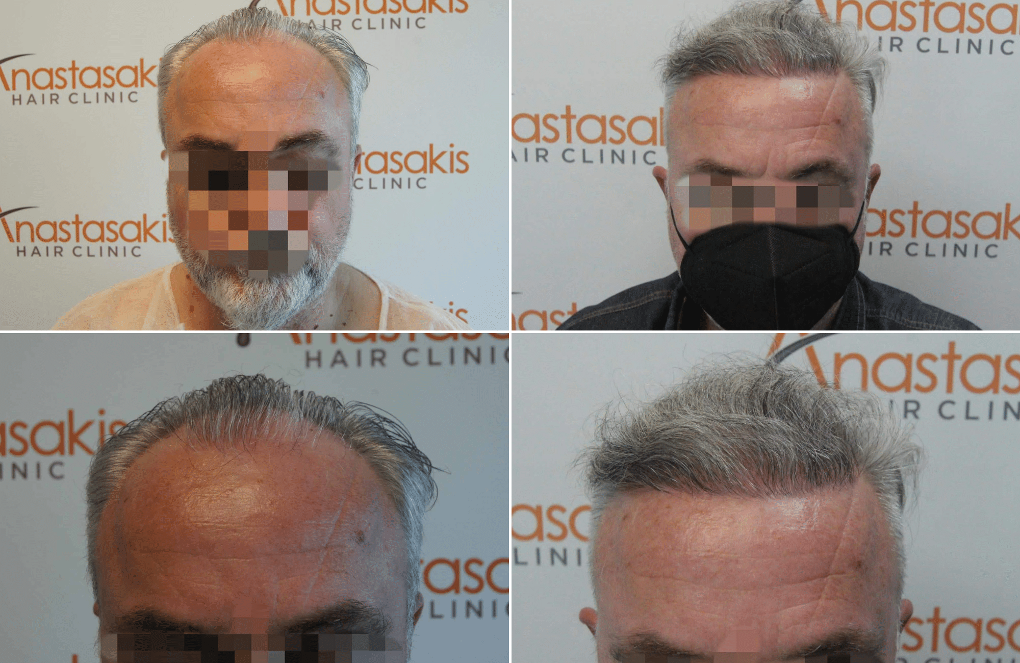 https://www.anastasakishairclinic.gr/portfolio/apotelesma-metamosxefsis-mallion-anastasakis-hair-clinic-128/