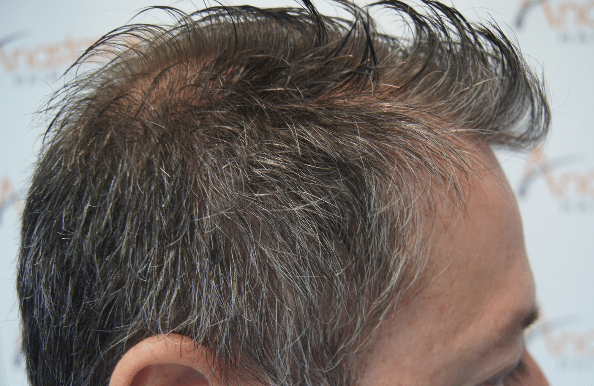 hair transplant result