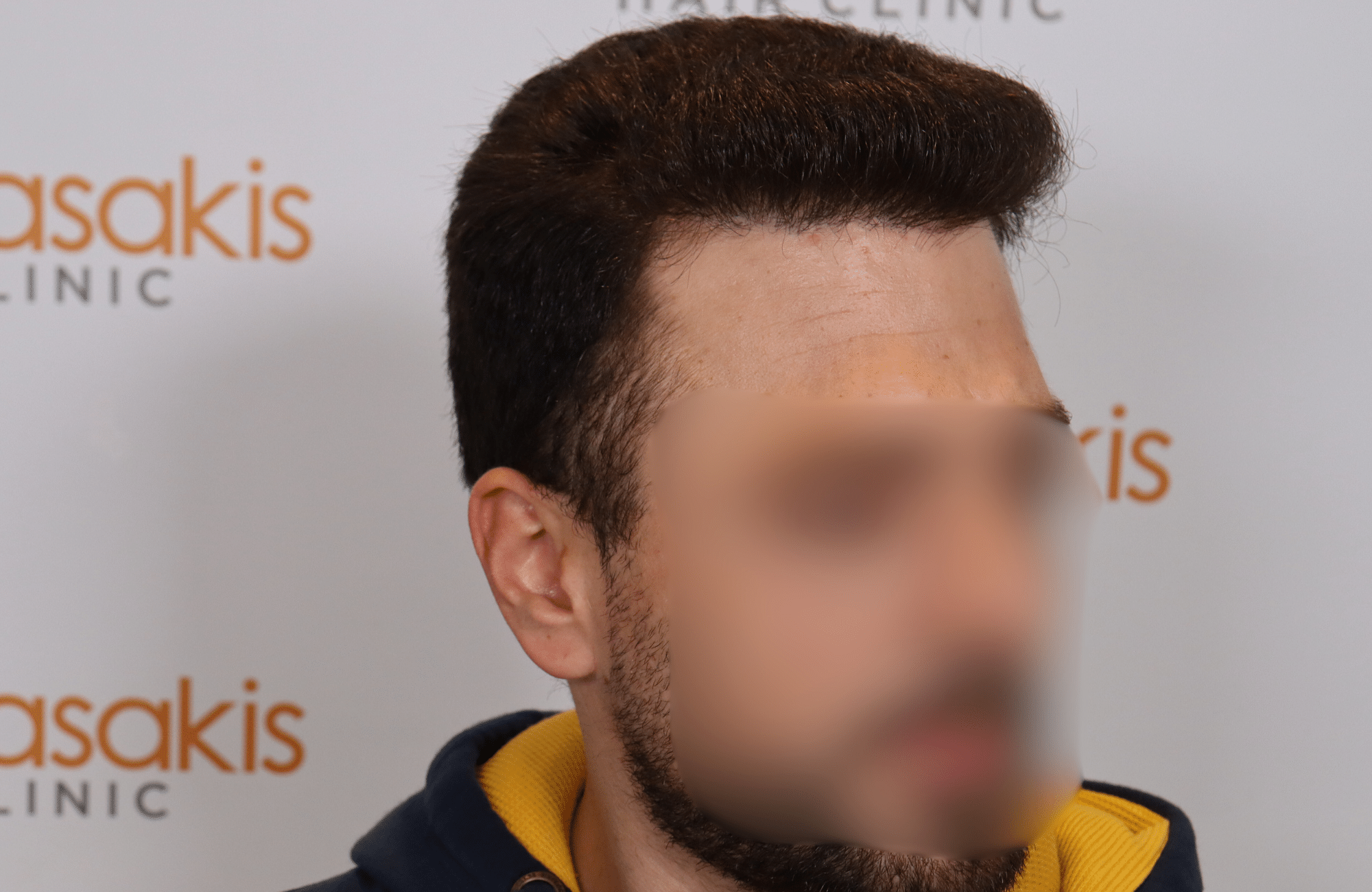 hair transplant result