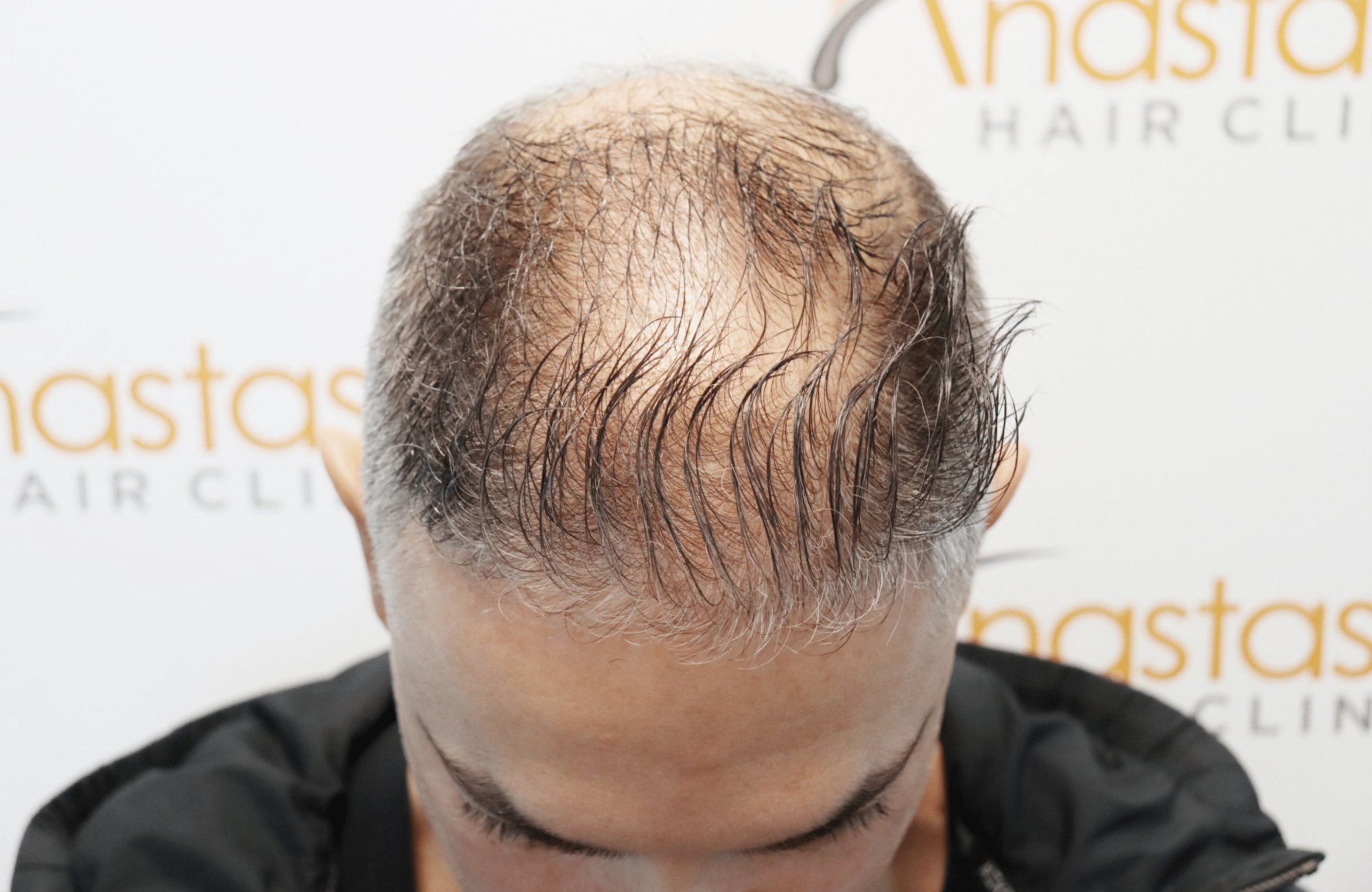 hair transplant result 2600 fus