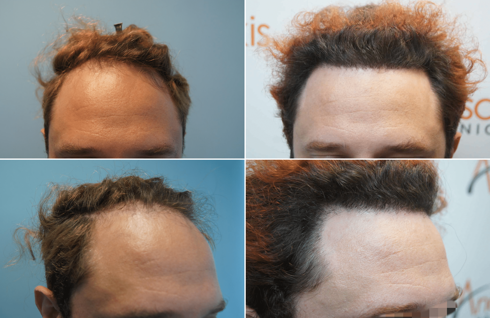 https://www.anastasakishairclinic.gr/portfolio/apotelesma-metamosxefsis-mallion-anastasakis-hair-clinic-131/