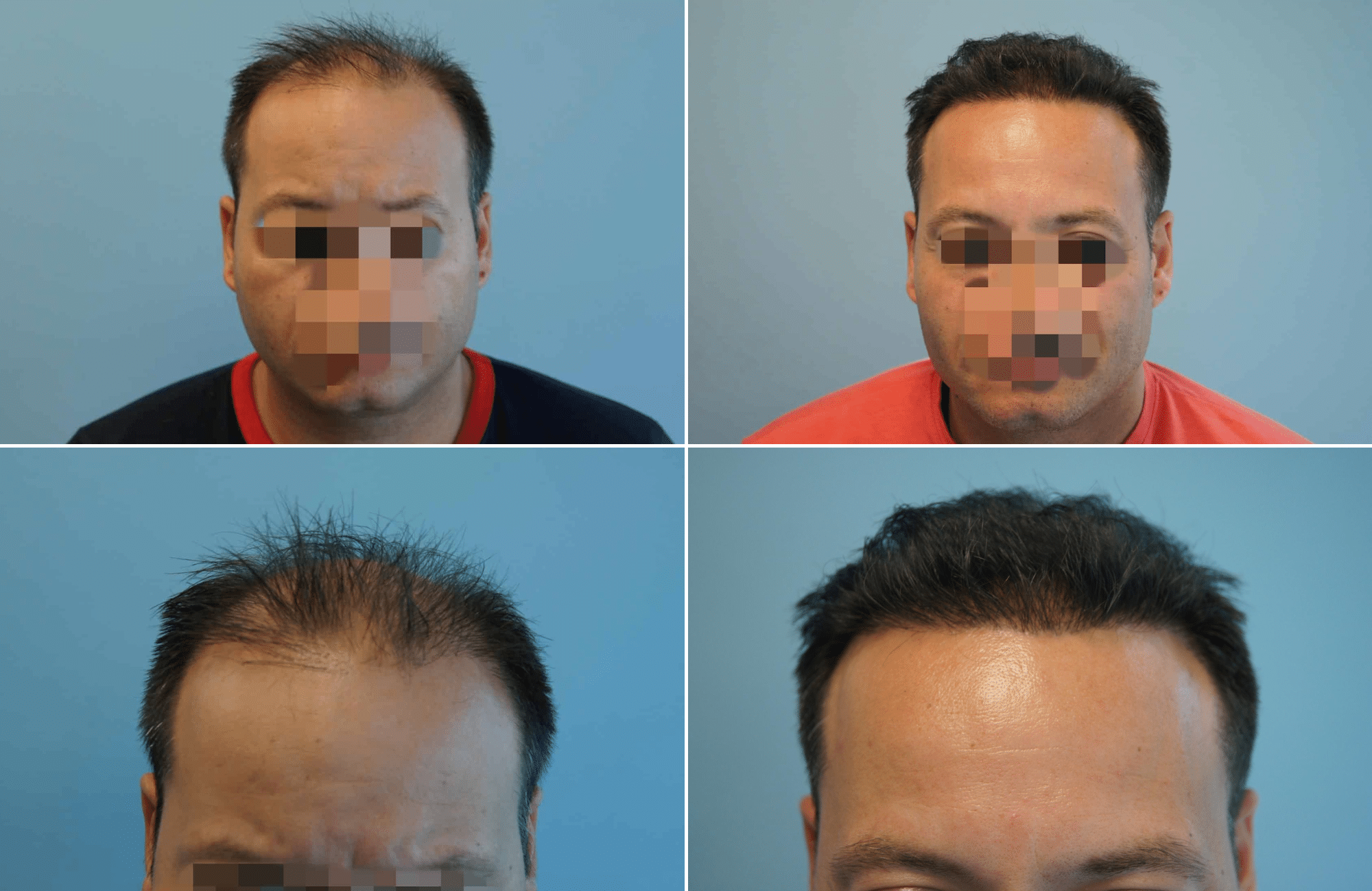 https://www.anastasakishairclinic.gr/portfolio/apotelesma-metamosxefsis-mallion-anastasakis-hair-clinic-132/