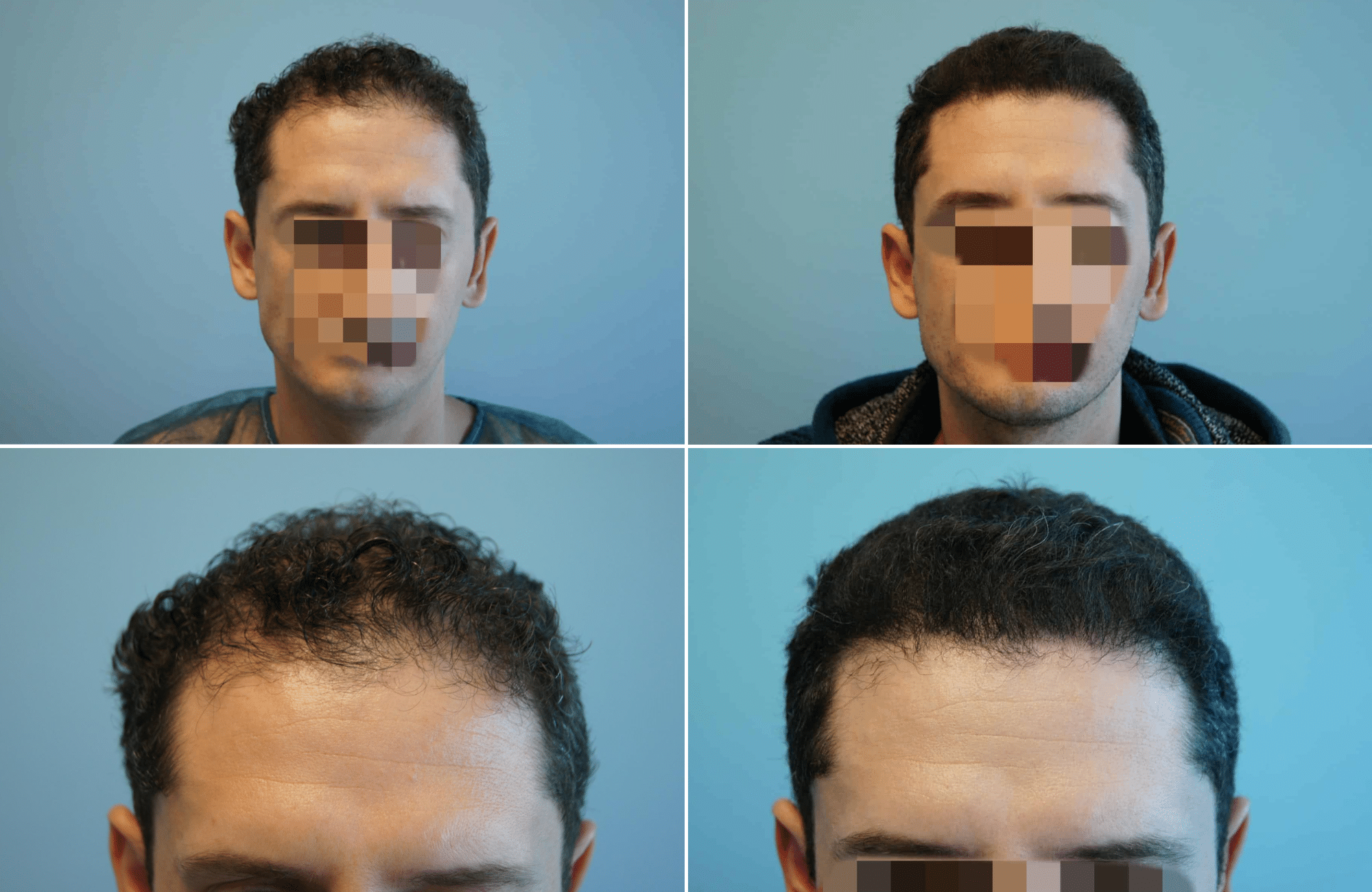 https://www.anastasakishairclinic.gr/portfolio/apotelesma-metamosxefsis-mallion-anastasakis-hair-clinic-133/