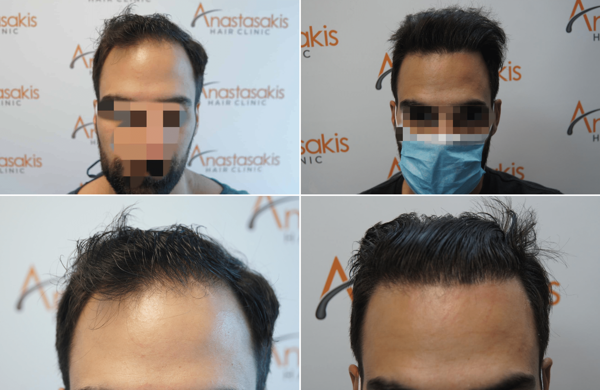 https://www.anastasakishairclinic.gr/portfolio/apotelesma-metamosxefsis-mallion-anastasakis-hair-clinic-137/