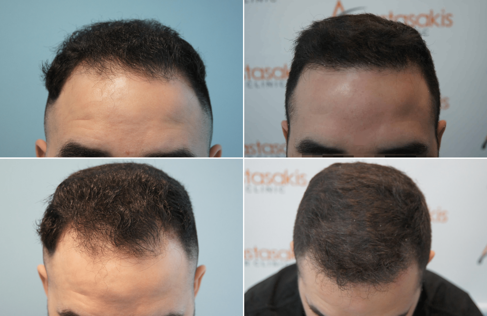 https://www.anastasakishairclinic.gr/portfolio/apotelesma-metamosxefsis-mallion-anastasakis-hair-clinic-139/