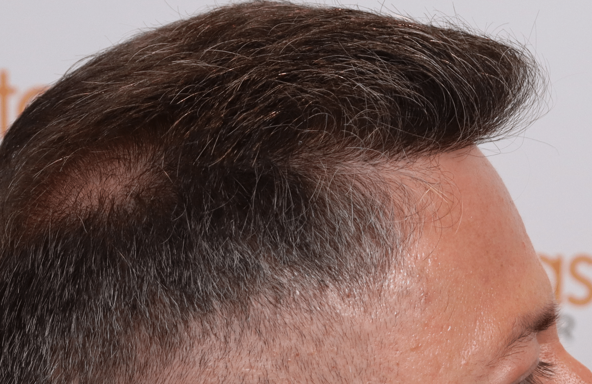 hair transplant result