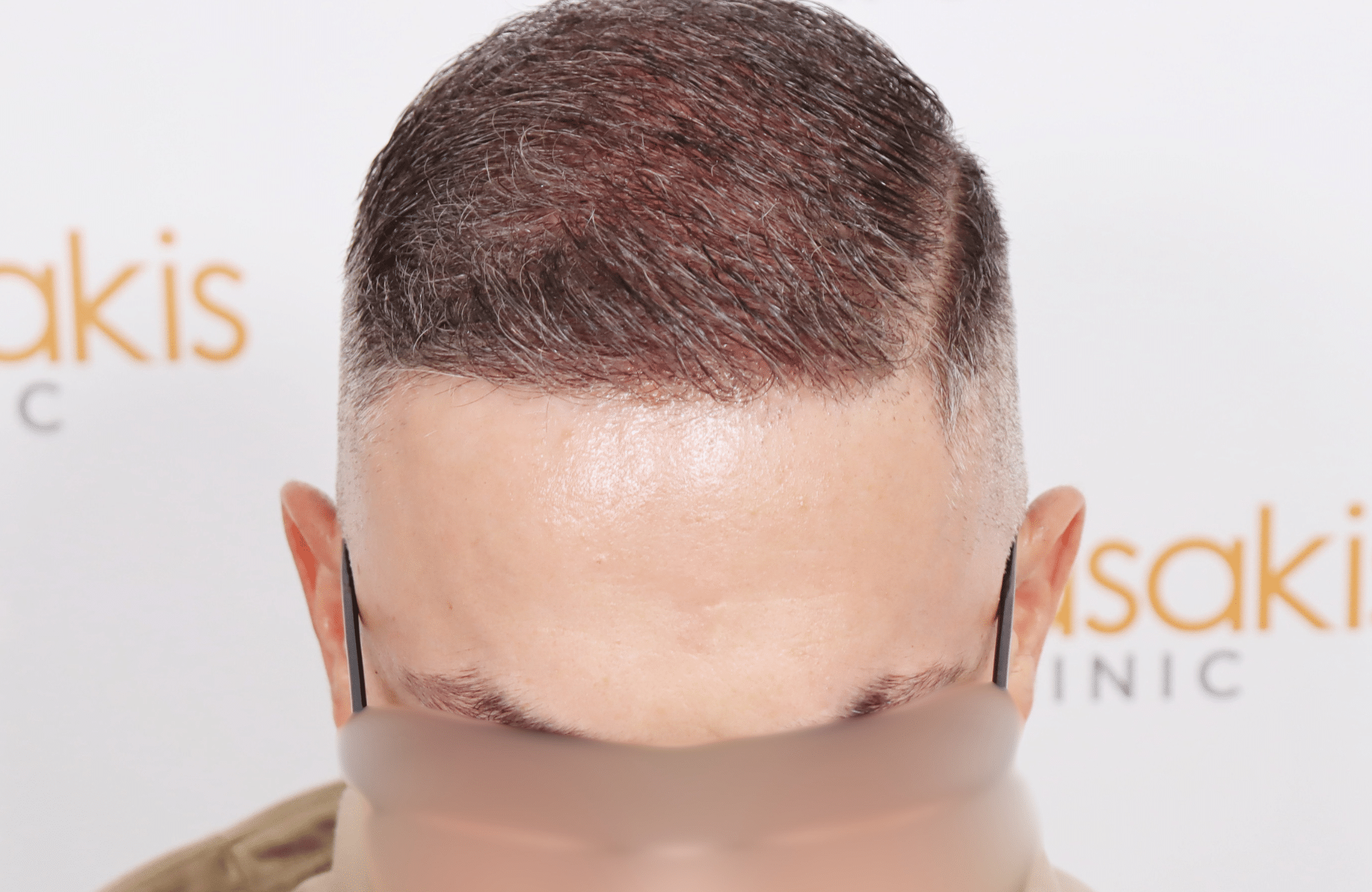 hair transplant result 2600 fus