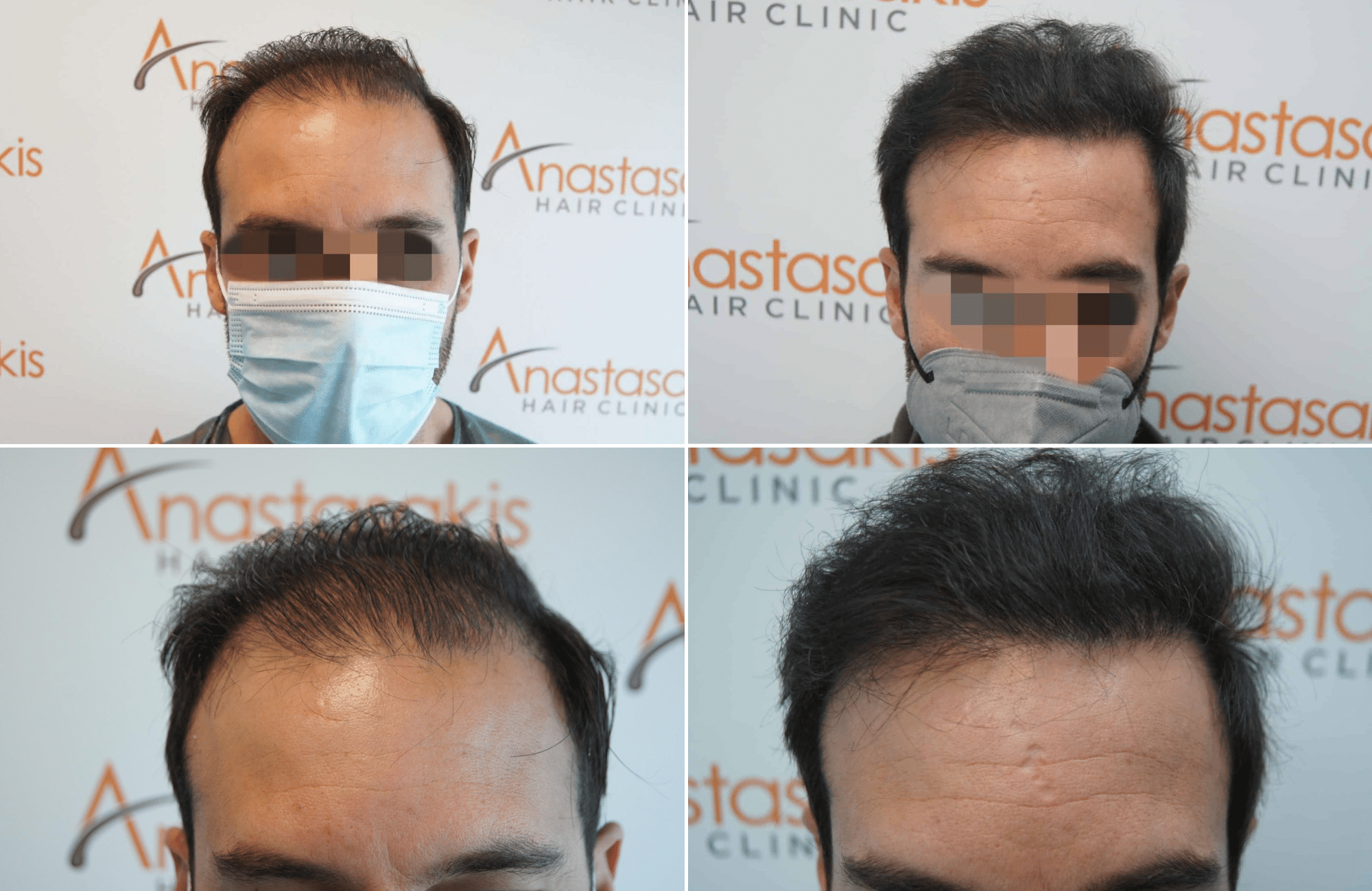 https://www.anastasakishairclinic.gr/portfolio/apotelesma-metamosxefsis-mallion-anastasakis-hair-clinic-140/
