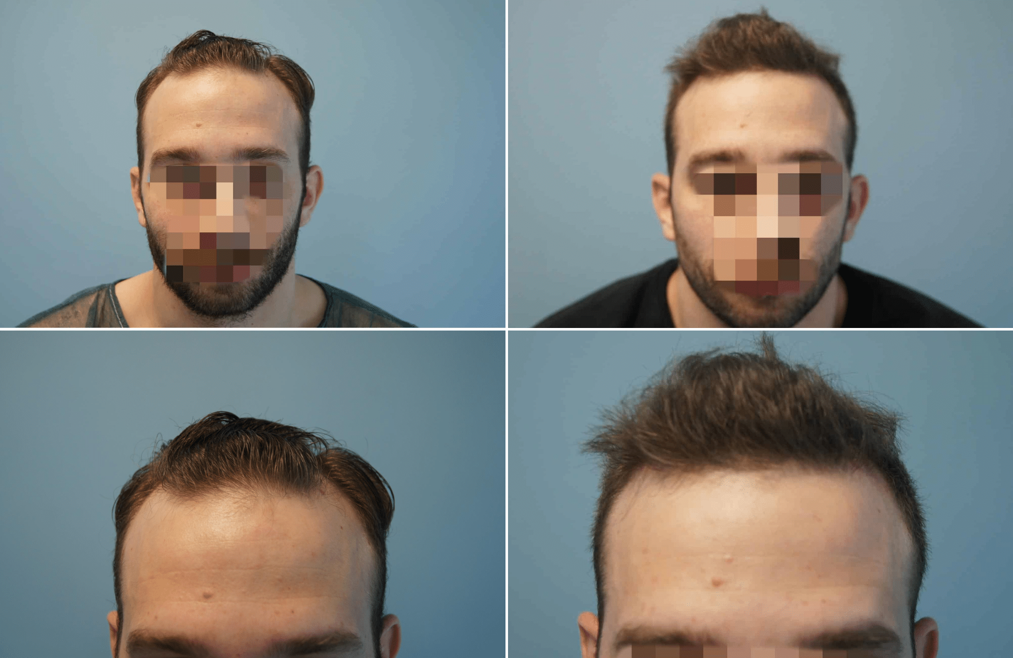 https://www.anastasakishairclinic.gr/portfolio/apotelesma-metamosxefsis-mallion-anastasakis-hair-clinic-141/