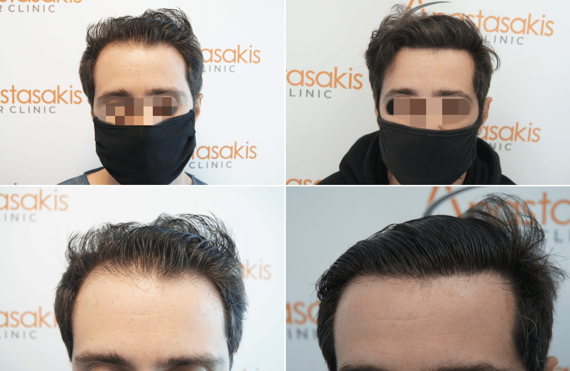 https://www.anastasakishairclinic.gr/portfolio/apotelesma-metamosxefsis-mallion-anastasakis-hair-clinic-145/
