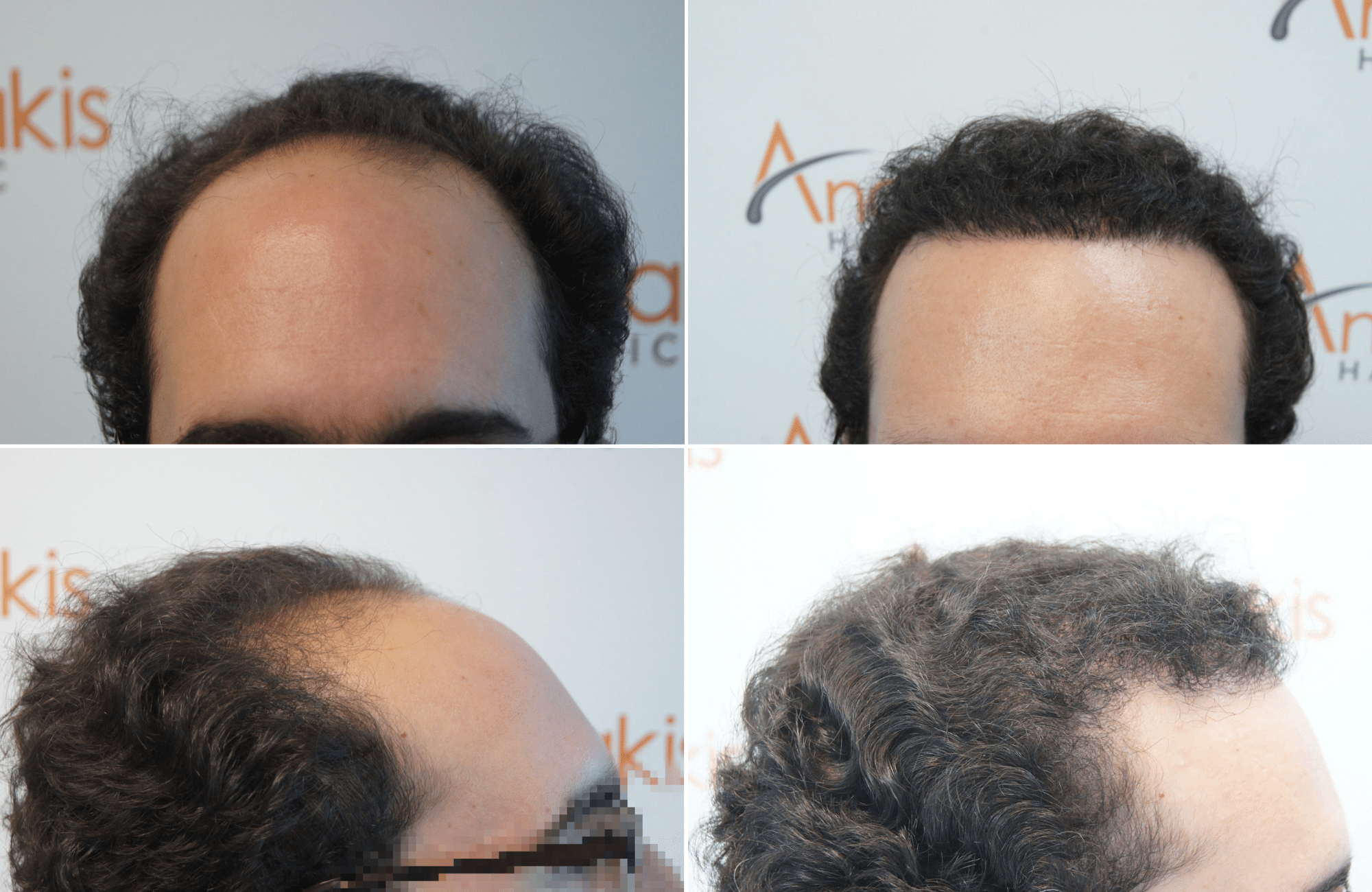 https://www.anastasakishairclinic.gr/portfolio/apotelesma-metamosxefsis-mallion-anastasakis-hair-clinic-148/