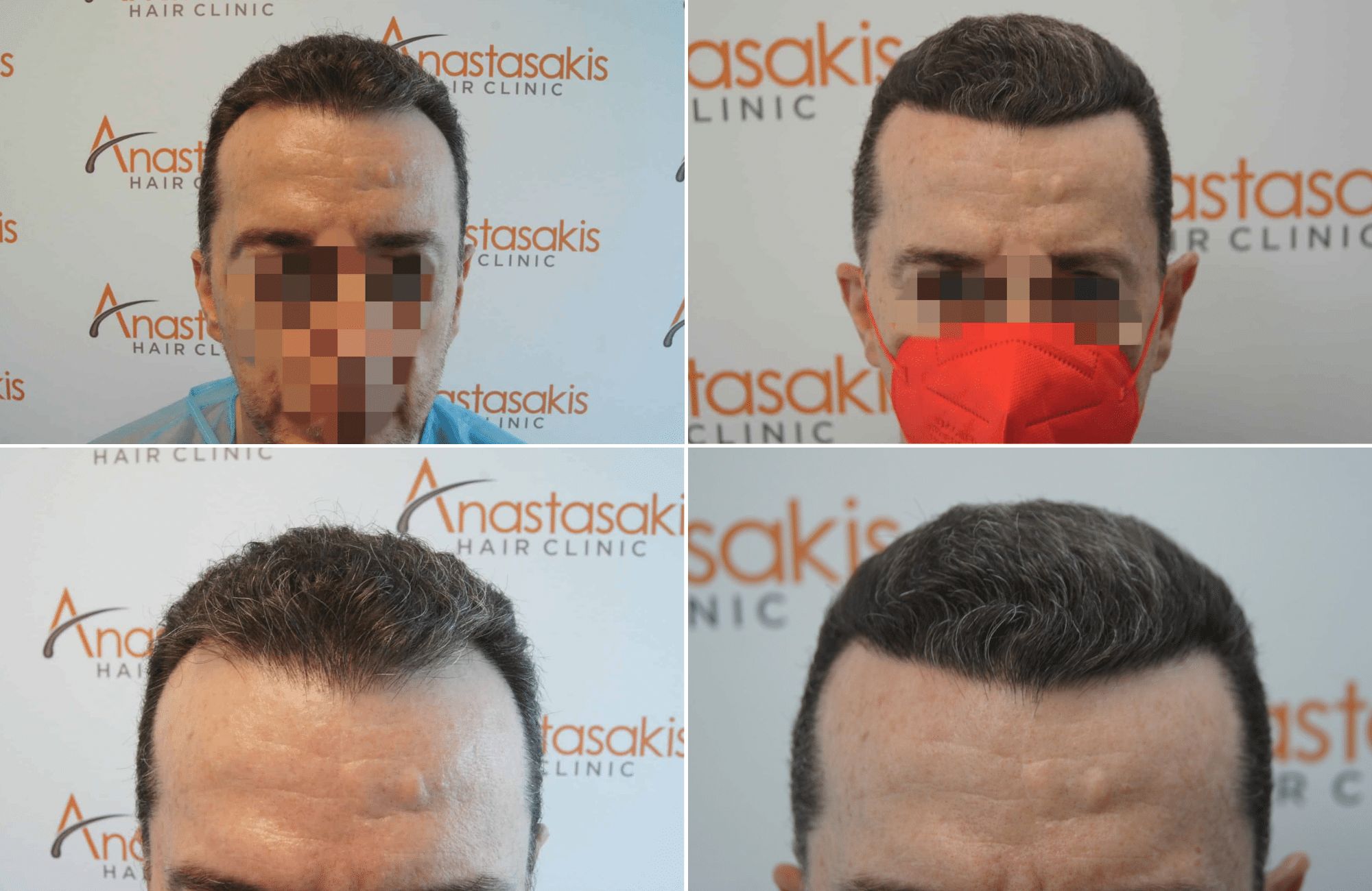 https://www.anastasakishairclinic.gr/portfolio/apotelesma-metamosxefsis-mallion-anastasakis-hair-clinic-153/