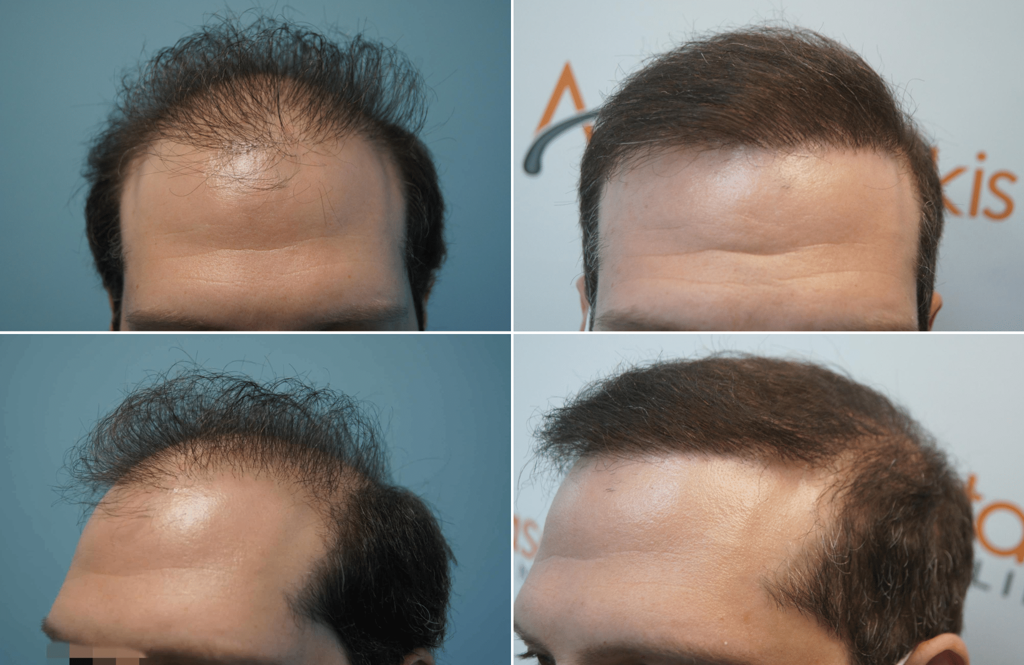 https://www.anastasakishairclinic.gr/portfolio/apotelesma-metamosxefsis-mallion-anastasakis-hair-clinic-157/