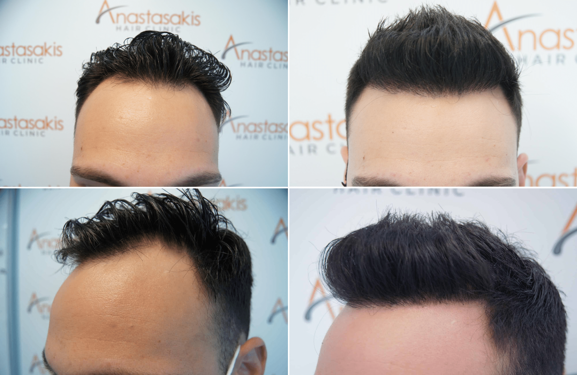 https://www.anastasakishairclinic.gr/portfolio/apotelesma-metamosxefsis-mallion-anastasakis-hair-clinic-158/