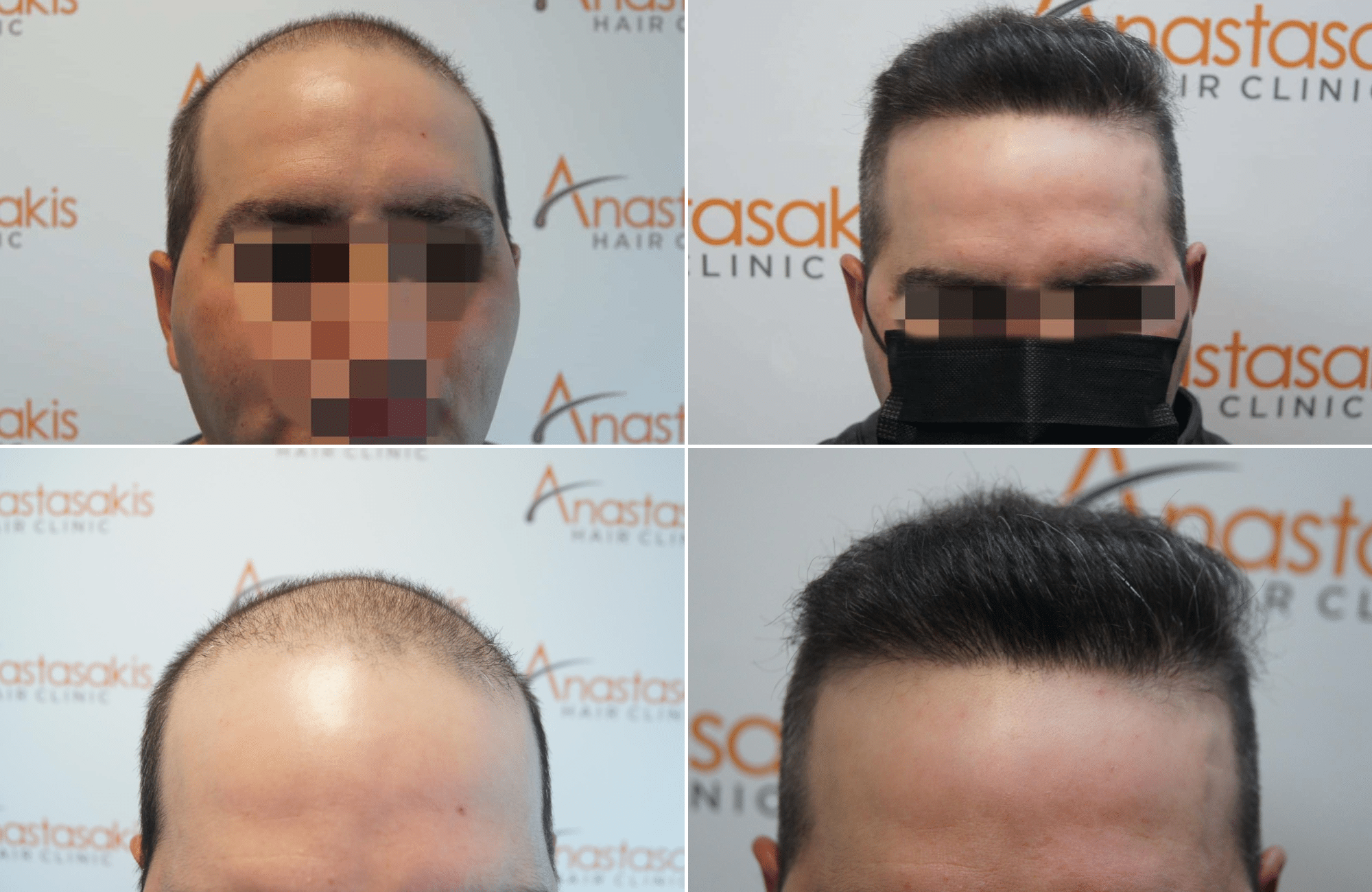 https://www.anastasakishairclinic.gr/portfolio/apotelesma-metamosxefsis-mallion-anastasakis-hair-clinic-159/
