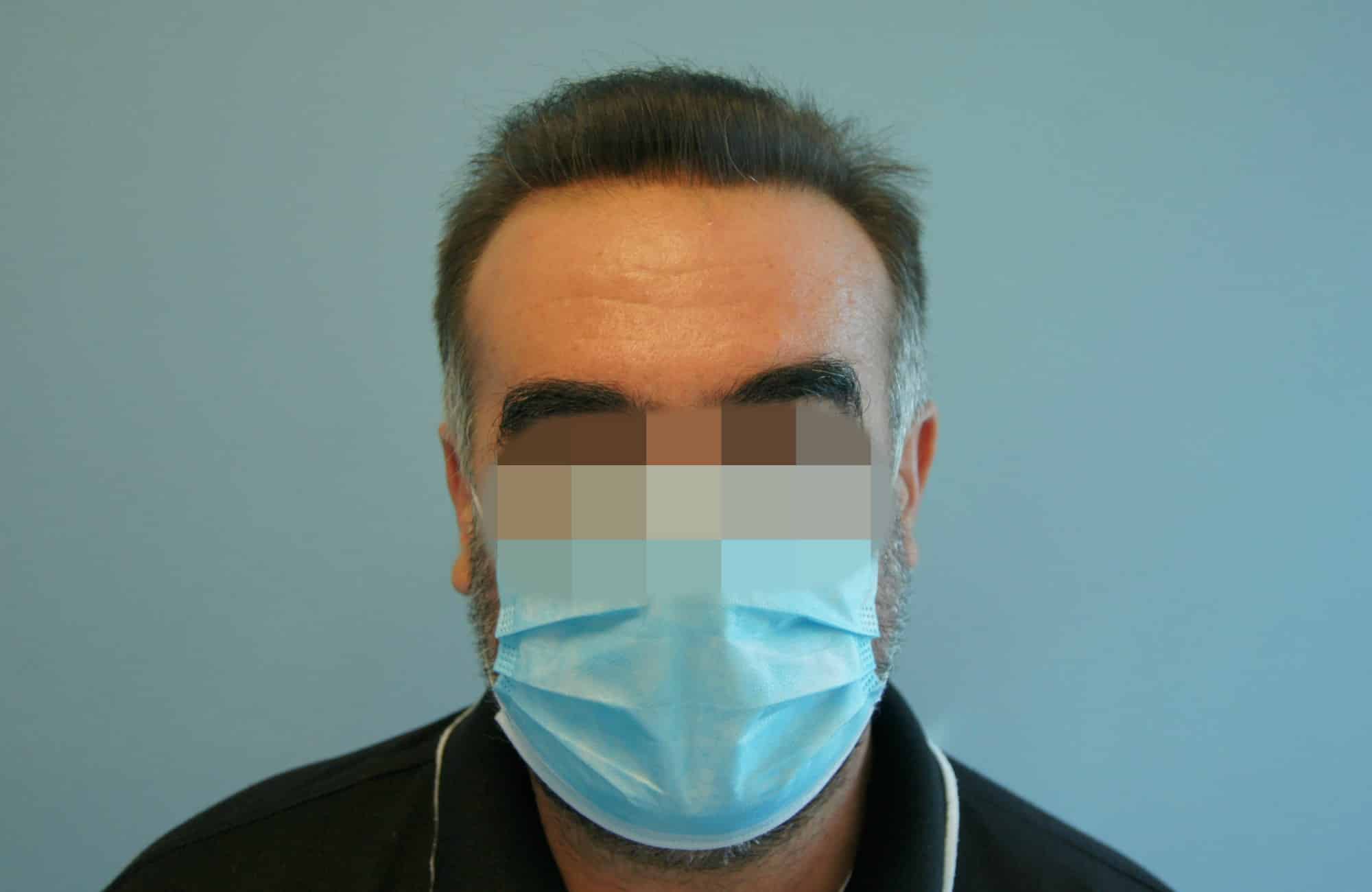 μεταμοσχευση μαλλιων πριν και μετα