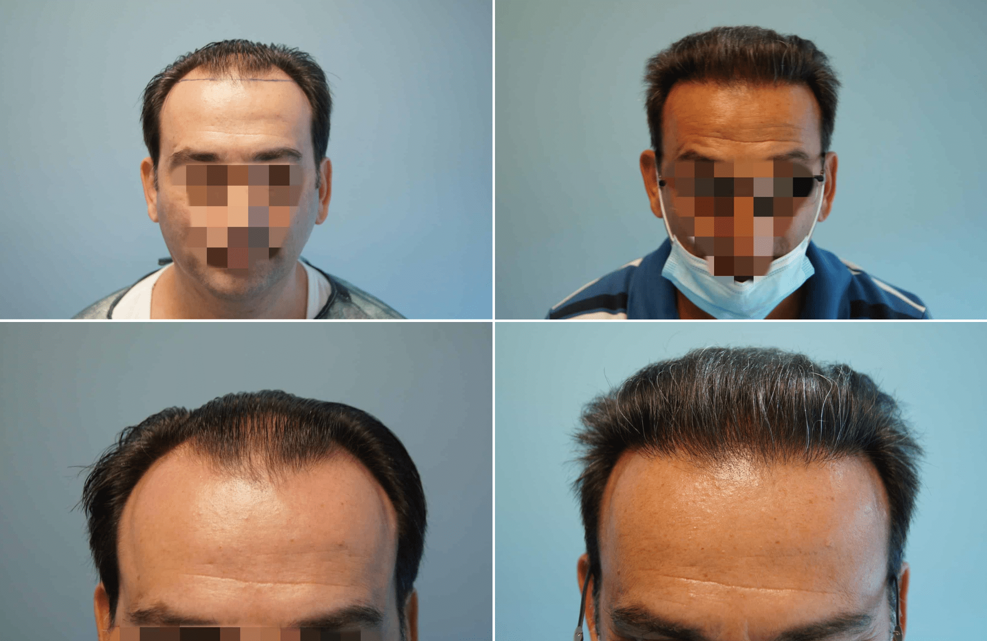 https://www.anastasakishairclinic.gr/portfolio/apotelesma-metamosxefsis-mallion-anastasakis-hair-clinic-160/