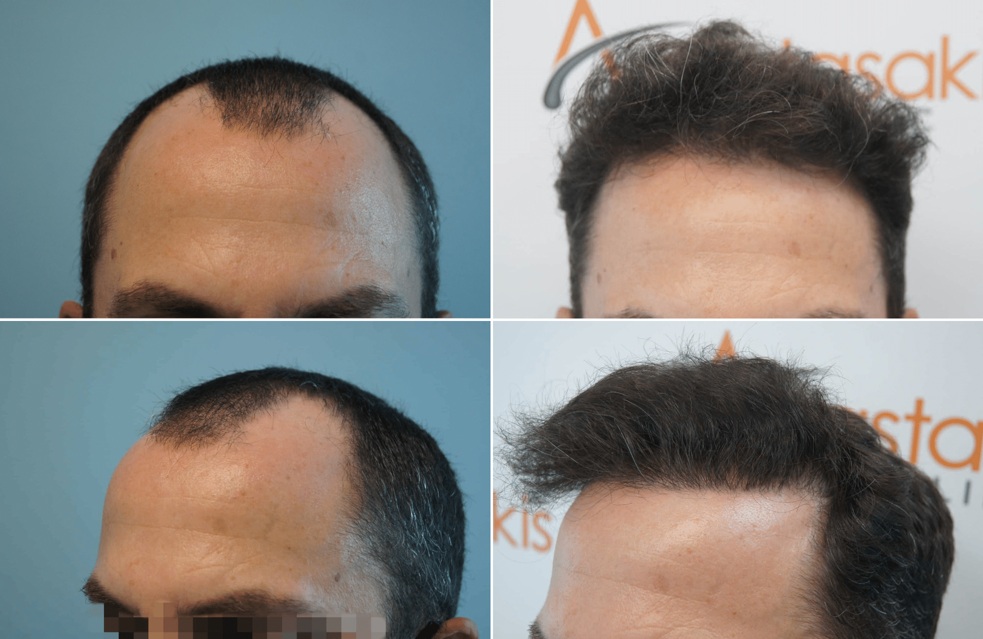 https://www.anastasakishairclinic.gr/portfolio/apotelesma-metamosxefsis-mallion-anastasakis-hair-clinic-164/