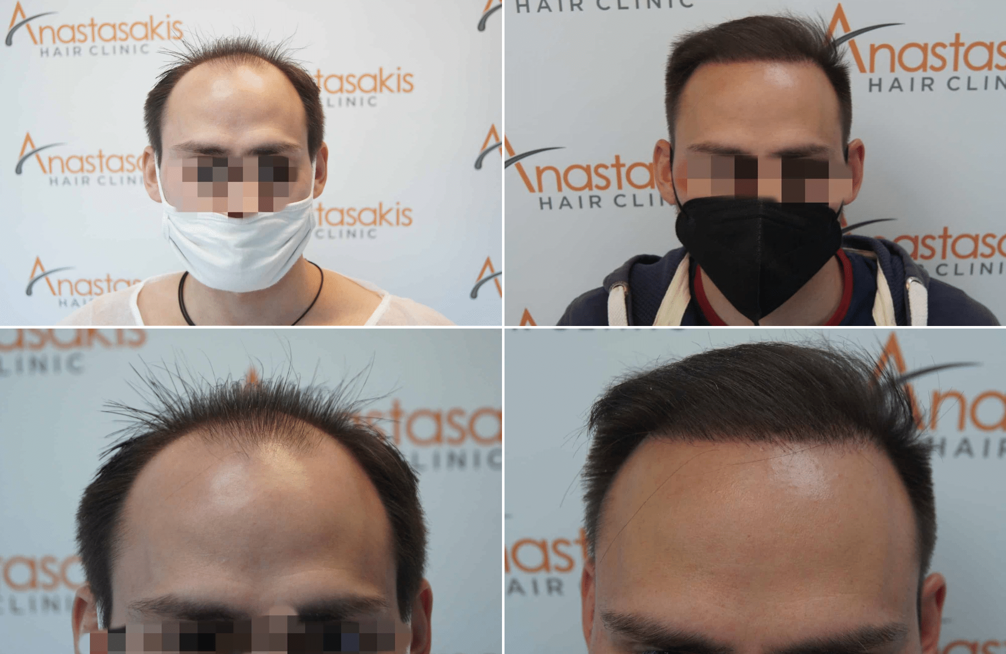 https://www.anastasakishairclinic.gr/portfolio/apotelesma-metamosxefsis-mallion-anastasakis-hair-clinic-169/